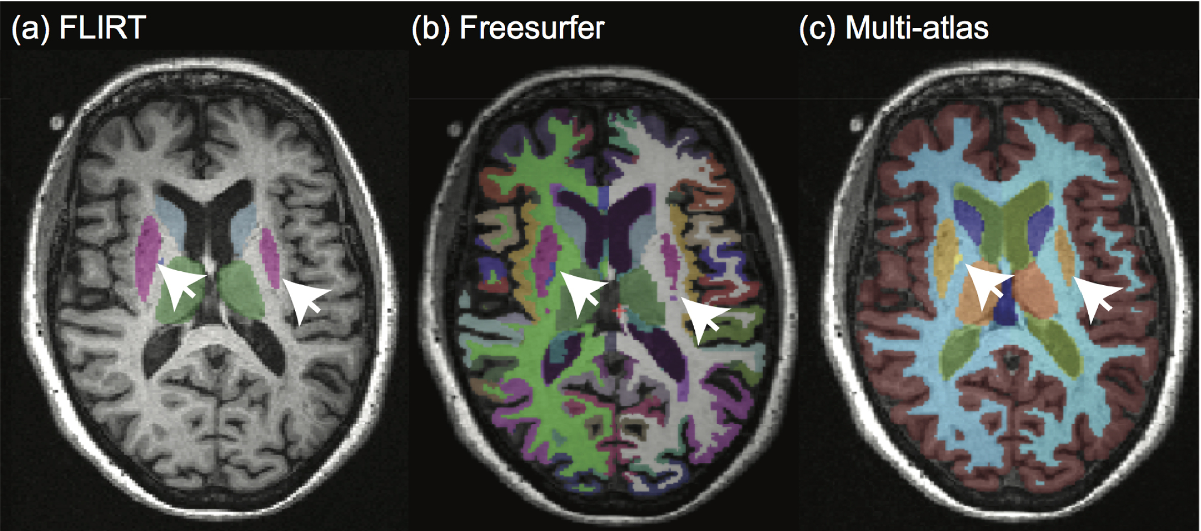 Subcortical segmentation output using FIRST, FreeSurfer and Multi-atlas segmentation in the same subject and slice location. Differences are evident in the segmentation of the putamen [pink in (a) and (b), dark yellow in (c)] and the pallidum [blue in (a) and (b), bright yellow in (c)].