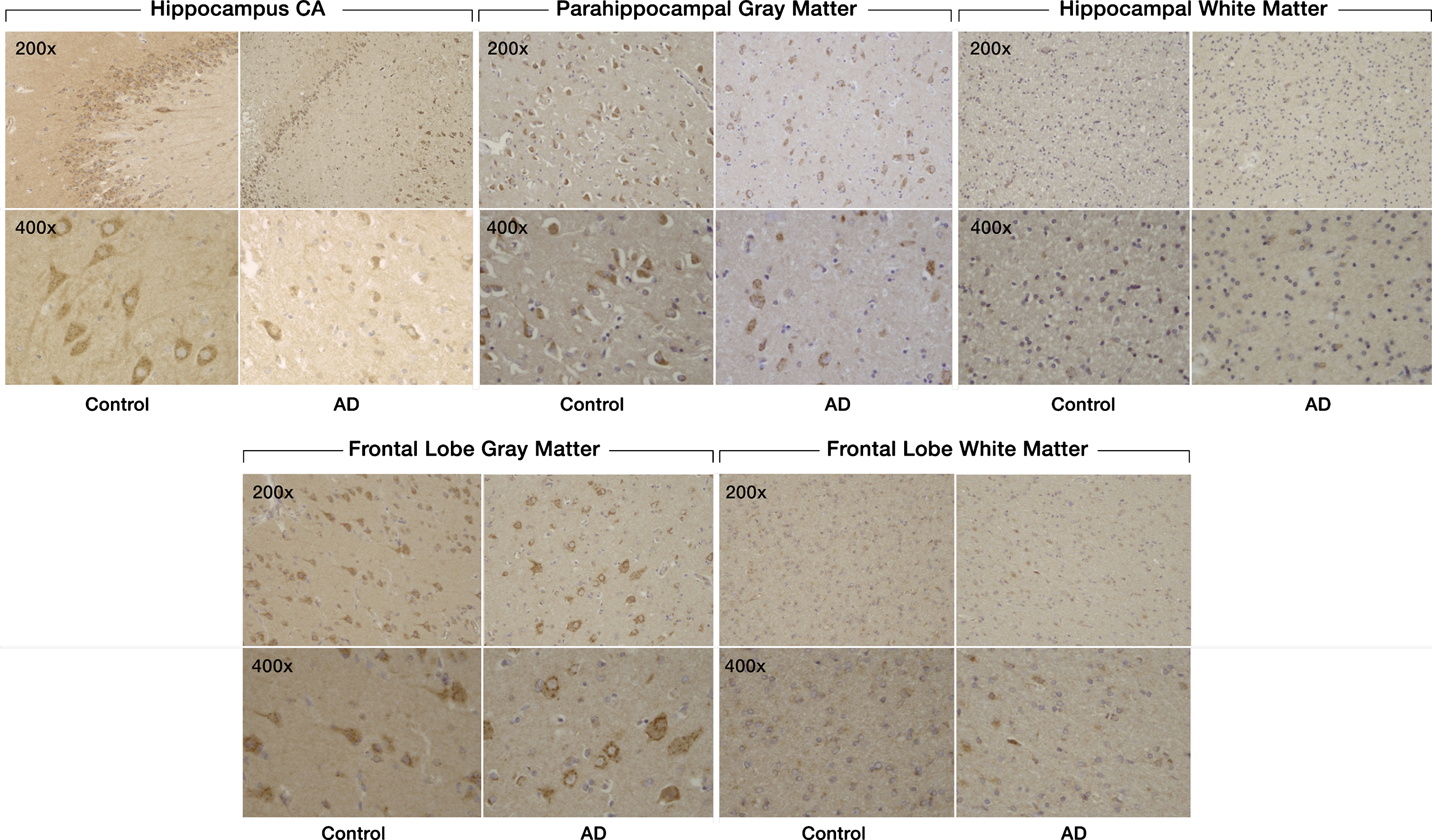 Expression of SULF2 in AD and cognitively normal control brain tissue. Immunohistochemical staining of SULF2 in the hippocampus and frontal lobe. There is less density of staining and a smaller proportion of cells are stained in the hippocampus CA and parahippocampal gray matter, as well as in the frontal lobe gray matter, in AD cases compared to cognitively normal controls. The quantification of SULF2 staining in the CA region encompassed the entire CA region, including CA1.