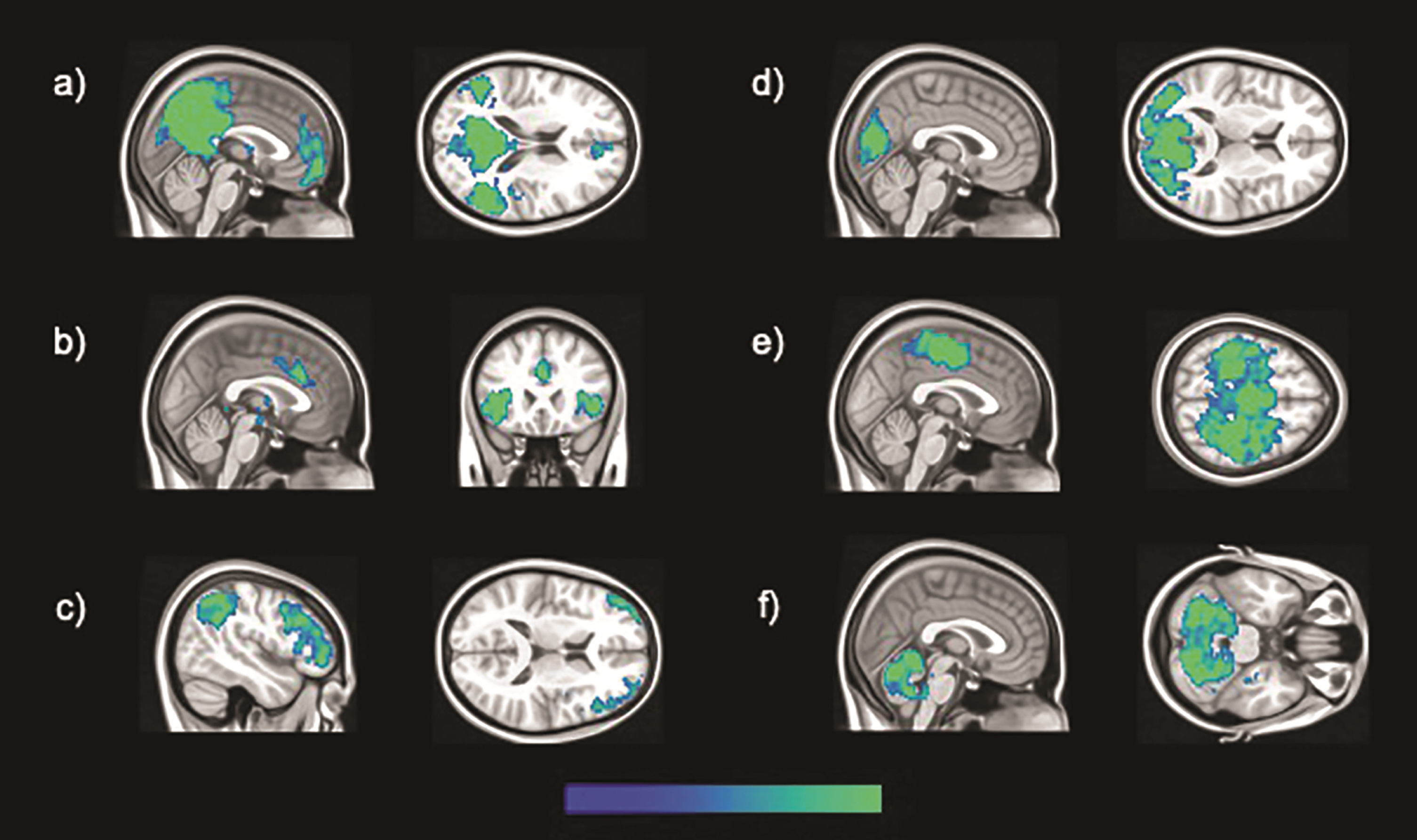 The six brain large-scale brain functional networks investigated in this study, specifically: a) DMN, b) salience, c) fronto-parietal, d) occipital, e) sensory-motor, and f) cerebellar networks.