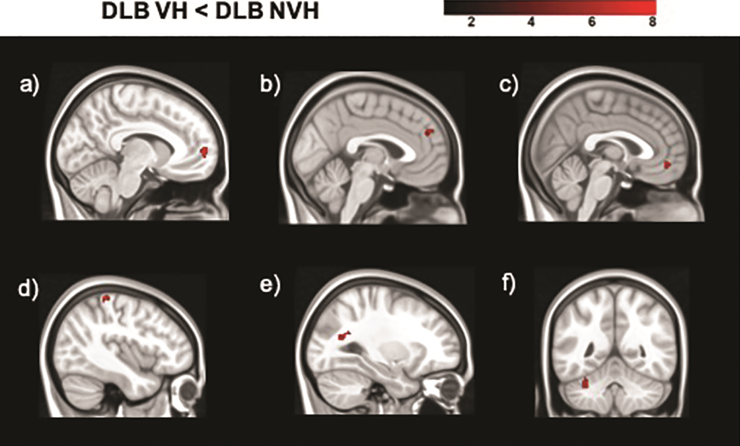 Regions of decreased functional connectivity in DLB patients with VH compared to those without obtained in the analyses of the following seeds: a) right putamen; b) left superior parietal lobule (BA 7); c) left lateral geniculate nucleus; d) right primary visual cortex (BA 17); e) right primary visual cortex (BA 17); f) left primary visual cortex (BA 17). The color bar indicates the z scores with the cluster-level threshold of p < 0.05 Family-Wise Error corrected for multiple comparisons with total intracranial volume and age as covariates of no interest.