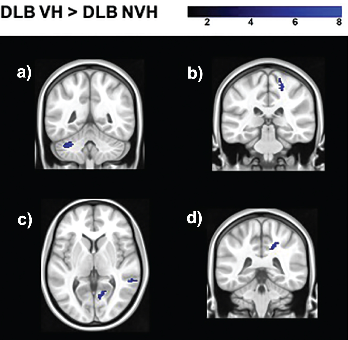 Regions of increased functional connectivity in DLB patients with VH compared to those without obtained in the analyses of the following seeds: a) right superior parietal lobule (BA 7); b) right secondary visual cortex (BA 18); c) right lateral geniculate nucleus; d) right putamen. The color bar indicates the z scores with the cluster-level threshold of p < 0.05 Family-Wise Error corrected for multiple comparisons with total intracranial volume and age as covariates of no interest.