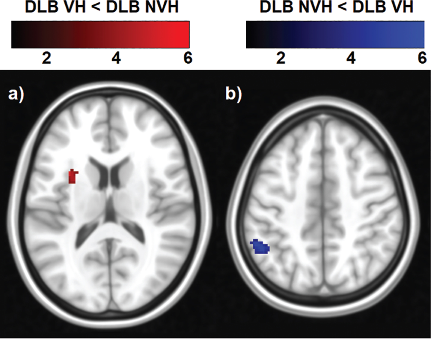 Regions of decreased and increased functional connectivity within the DMN in DLB patients with VH compared with those without. The color bar indicates the z scores with a cluster-level threshold of p < 0.05 Family-Wise Error corrected for multiple comparisons with total intracranial volume and age as covariates of no interest.