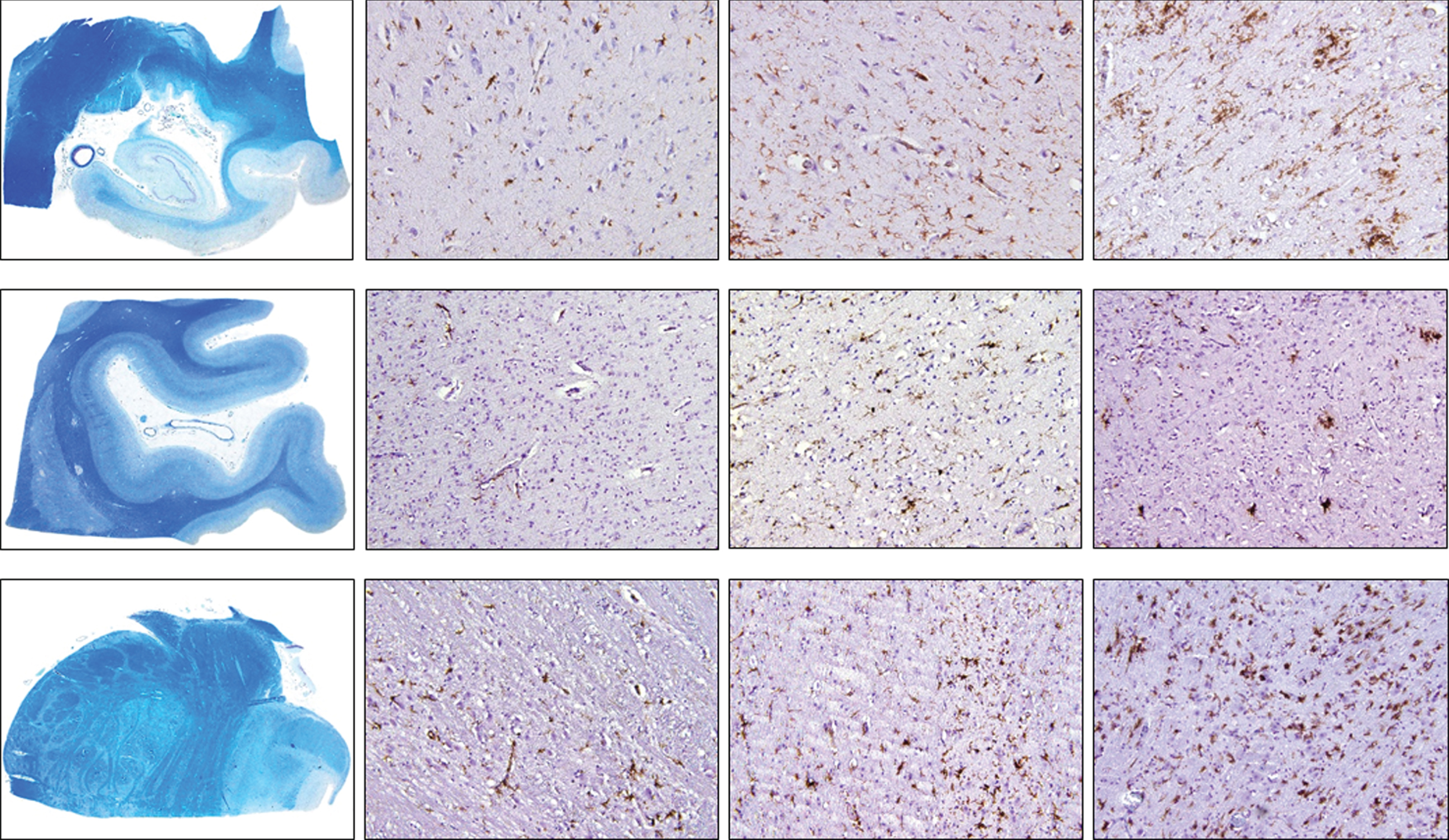 Density of HLA-DR-positive cells in control, intermediate and late AD, respectively (upper row, hippocampus; middle row, occipital cortex, lower row, brainstem) (magnification 100x).