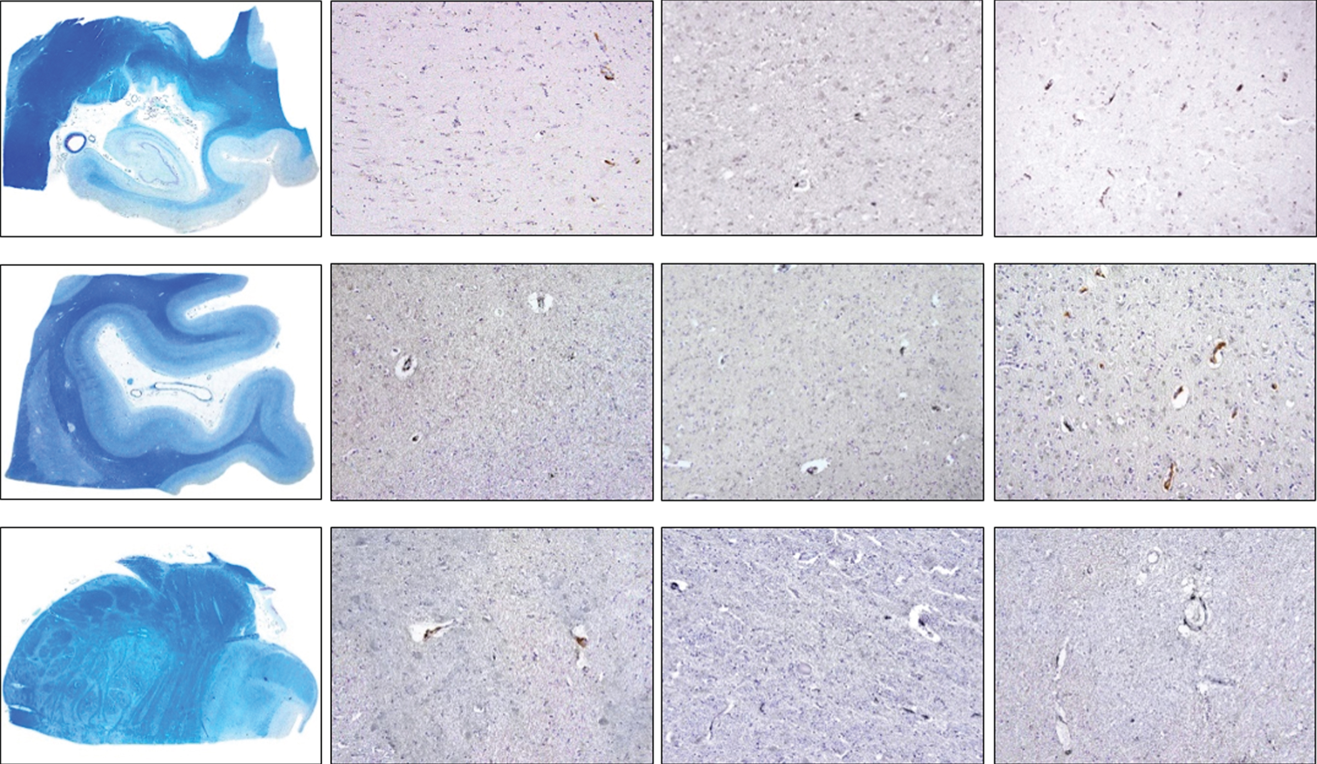 Density of CD206-positive cells in control, intermediate and late AD, respectively (upper row, hippocampus; middle row, occipital cortex, lower row, brainstem) (magnification 100x).