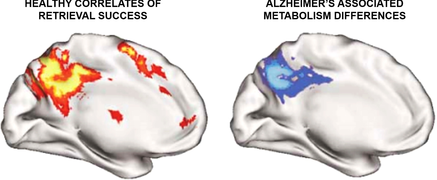 Correlates of memory retrieval in young adults converge with the same regions that show metabolic change in Alzheimer’s disease. (Left) fMRI retrieval success effects are plotted for the medial surface of the cortex, showing regions more active when healthy, young adults correctly remember items from their past. (Right) The correlation between Alzheimer’s disease severity and FDG-PET resting glucose metabolism is plotted for a sample of nearly 400 patients. Brighter colors represent regions showing reduced metabolism as the disease becomes more severe. Note the strong correlation between impairment and hypometabolism near precuneus extending into posterior cingulate and retrosplenial cortex. The correspondence is notable, as the retrosplenial cortex has dense reciprocal projections to the hippocampus and parahippocampal gyrus. Retrieval success effects and metabolism differences may thus be reflecting function (Left) and dysfunction (Right) of cortical networks subserving memory. Reprinted from Neuron, Vol 44, Buckner, Memory and executive function in aging and AD: multiple factors that cause decline and reserve factors that compensate, 195–208, 2004 [24], with permission from Elsevier.