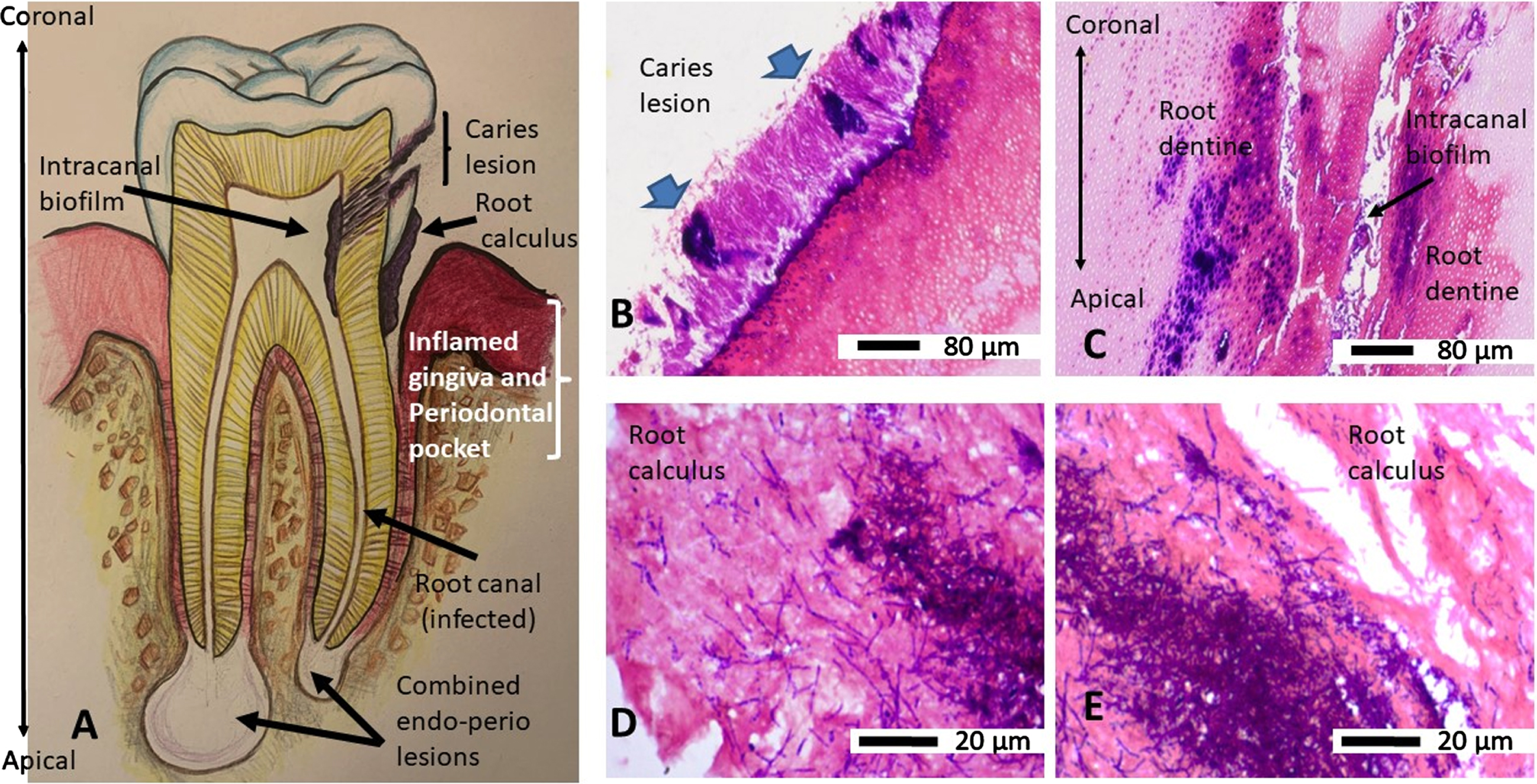 An overview and orientation of a diseased tooth (line drawing) and Gram’s stain characteristics of the infecting bacteria. Panel A is a line drawing of a tooth as a map for the tissues and their orientation in Gram-stained images. B) Demineralized, paraffin wax embedded, rehydrated section of a tooth from a primary root canal infection (Group A) showing a carious lesion with clusters of Gram-positive (blue) bacteria (blue arrows) and Gram-variable bacteria on the external surface. C) Same tissue section as in B shows the infection had spread internally within the canal and dentinal tubules of the tooth. Double headed arrow indicates the coronal to apical orientation of the root canal space and adjacent root dentine with respect to panel A. D, E) Paraffin wax embedded, rehydrated sections of scraped root calculus shows both Gram-positive (blue) bacteria intermingled with filamentous and non-filamentous Gram-variable bacteria.