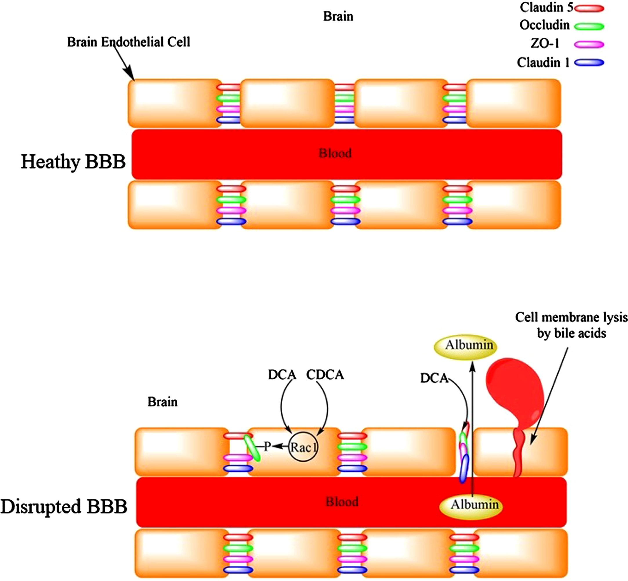 The disruption of the blood-brain barrier by bile acids leading to the leakage of serum proteins like albumin into the brain or microhemorrhages.