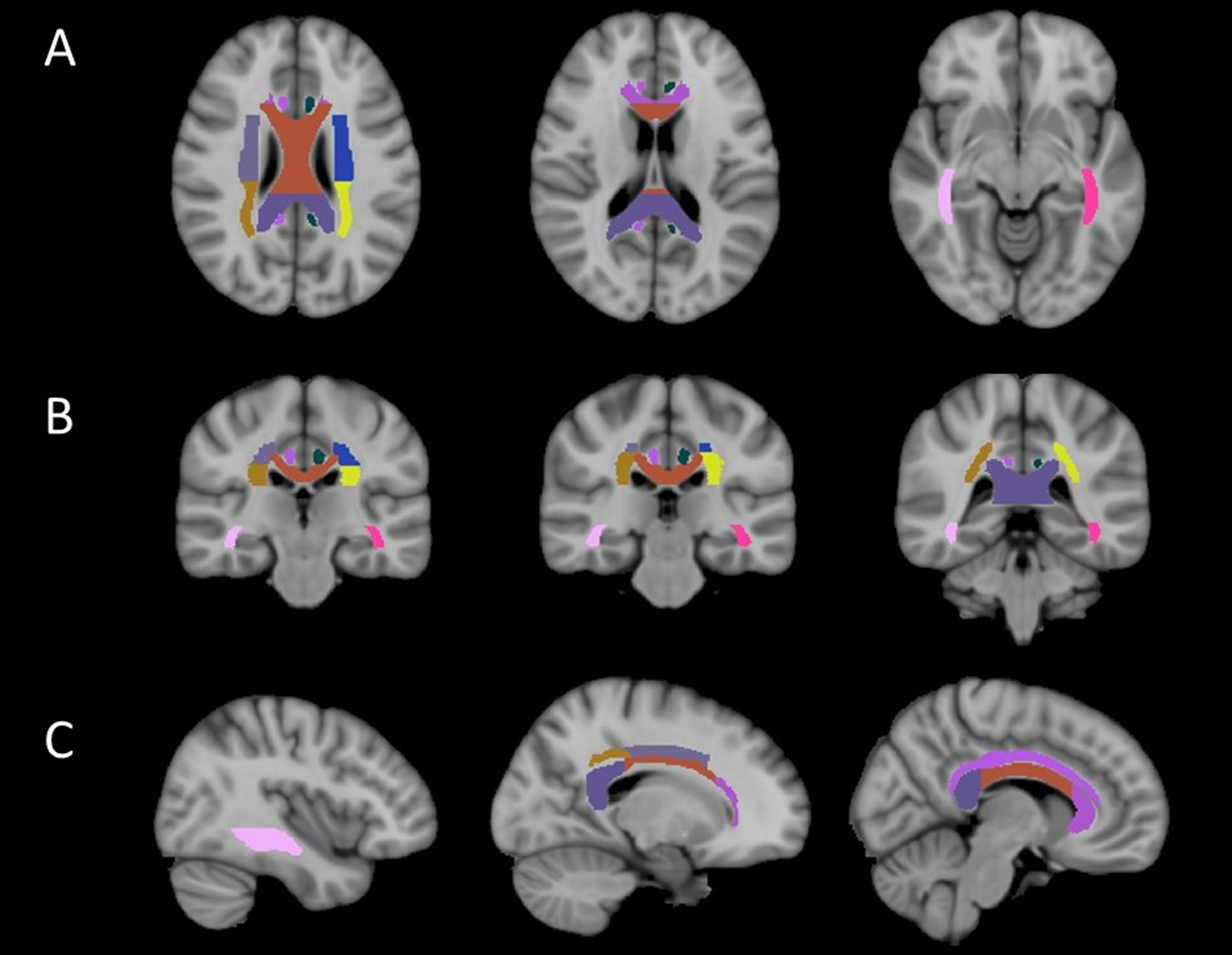 Altered white matter fiber tracts in one COPD patient. The integrity of nine fiber bundles was altered: bilateral superior/posterior corona radiata, splenium/genu/body of corpus callosum, bilateral cingulum, bilateral occipitofrontal fasciculus.