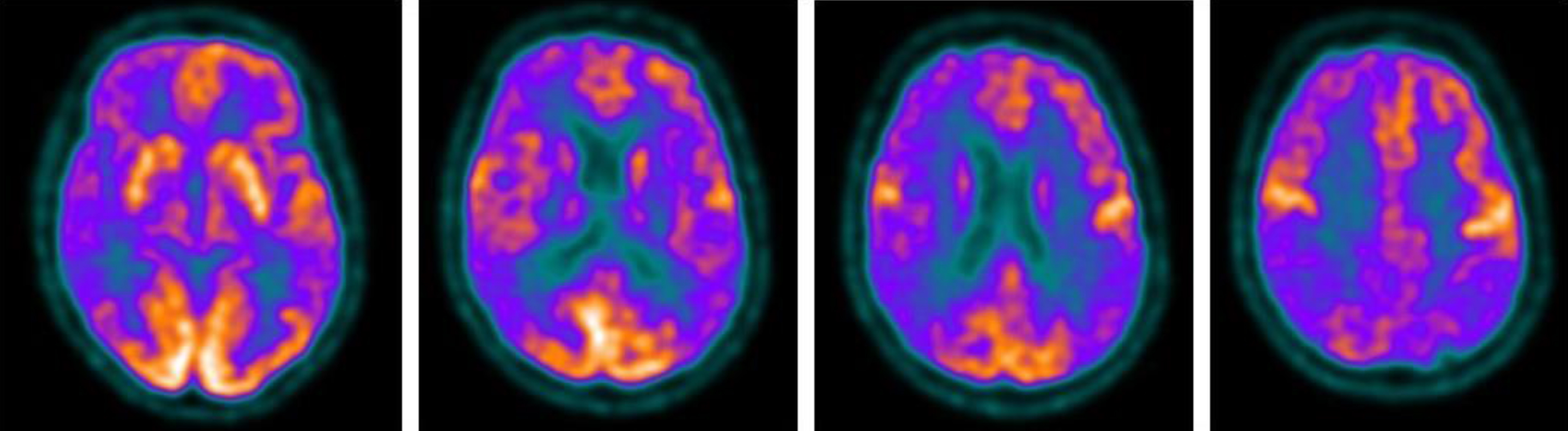 Brain 18F-FDG PET showed a severe cortical hypometabolism involving right frontal lobe, temporo-parietal lobe bilaterally, precuneus, and posterior cingulate cortex.