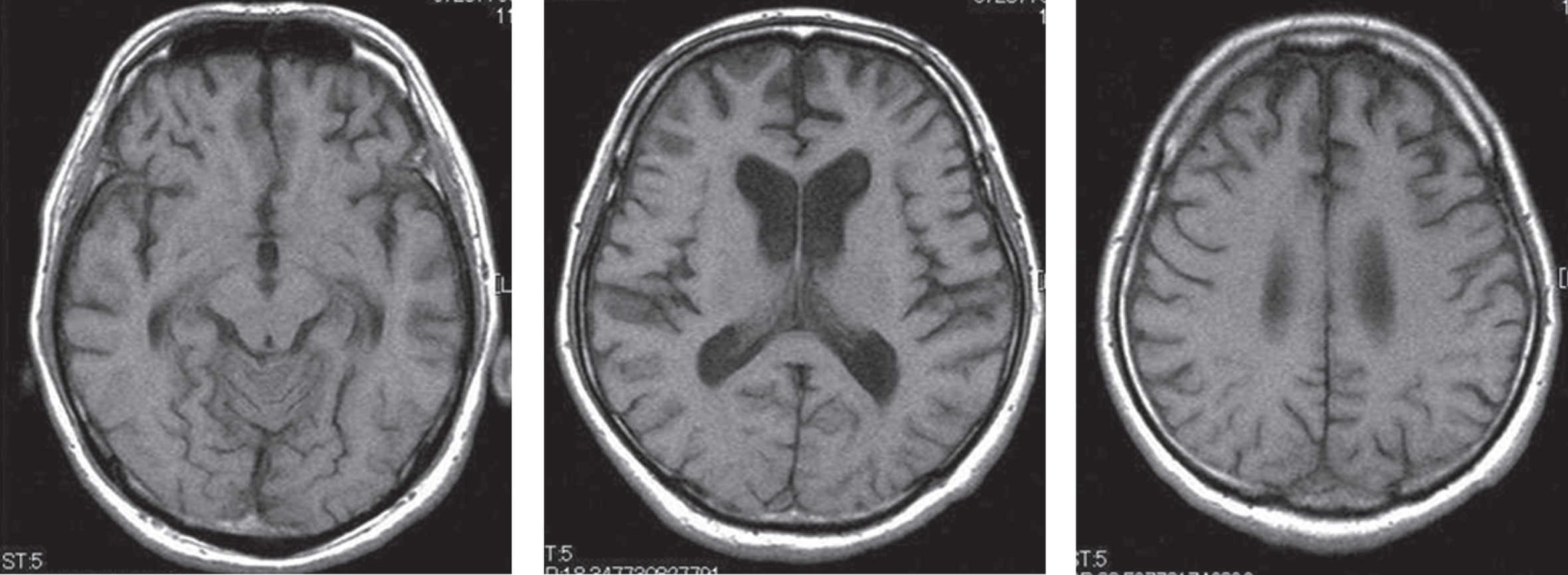 Our patient’s T1-weighted magnetic resonance imaging. Atrophy in the bilateral frontal lobe was demonstrated.