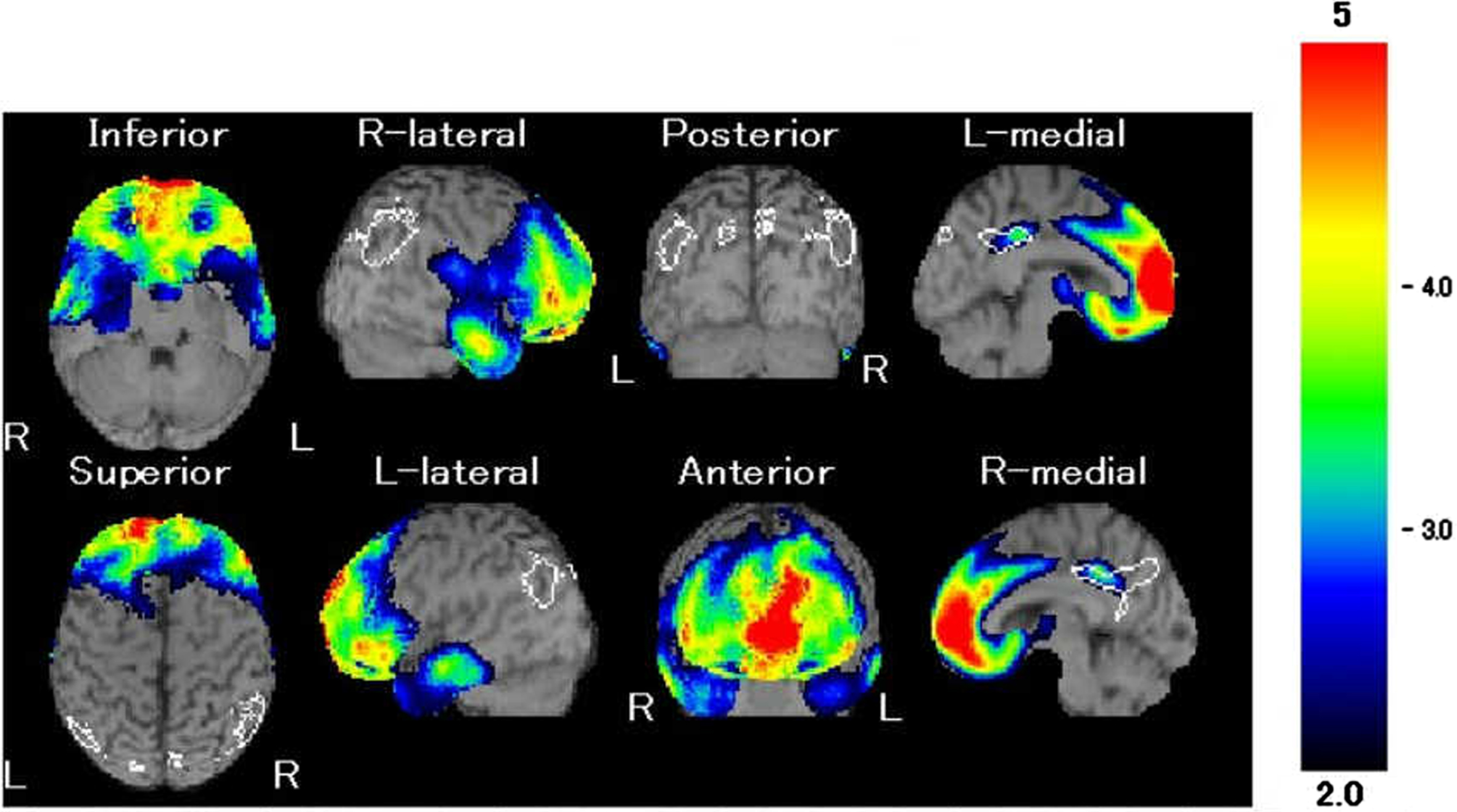 Our patient’s 99mTc-ethylcysteinate dimer single photon emission computed tomography. Red indicates areas of the strongest hypoperfusion (z score ≤ –5); blue is where hypoperfusion is significant (z score of of –2 to –3) when compared with neurotypical individuals. Hypoperfusion in the bilateral frontal lobe was demonstrated.