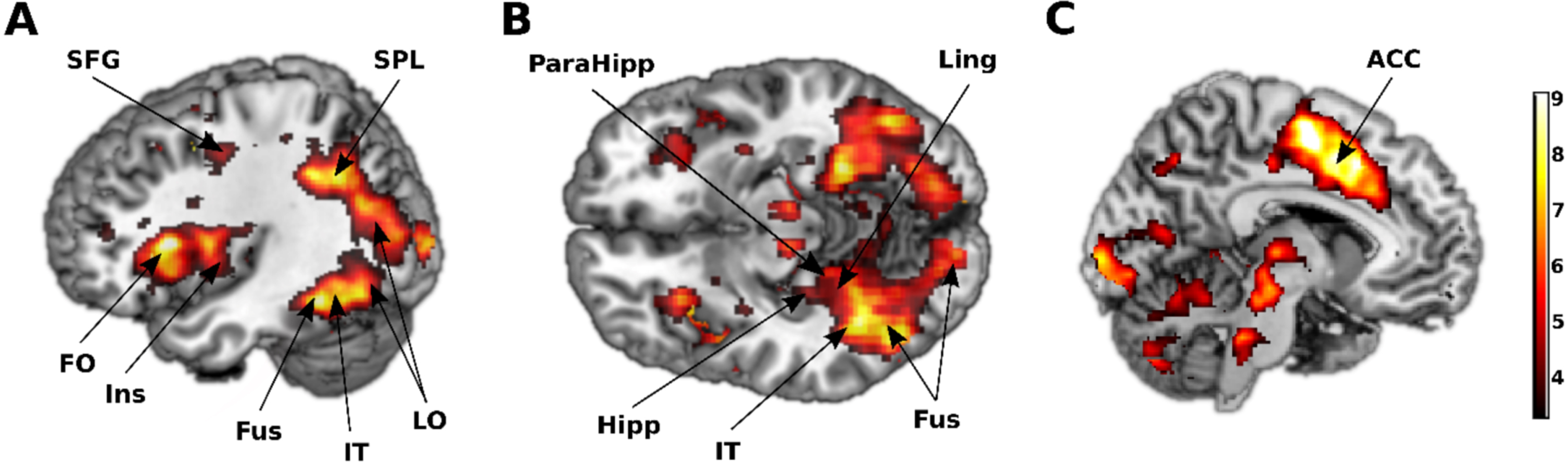 Several brain areas were activated during the ICA test. A) Lateral view. B) Inferior view. C) Medial view. Regions activated in response to images of animal and non-animal, FDR corrected at 0.05. SFG, superior frontal gyrus; SPL, superior parietal lobule; FO, frontal operculum; Ins, insula; Fus, fusiform; IT, inferior temporal; LO, lateral occipital; ParaHipp, parahippocampus; Hipp, hippocampus; Ling, lingual; ACC, anterior cingulate cortex. The color bar represents the T statistic.