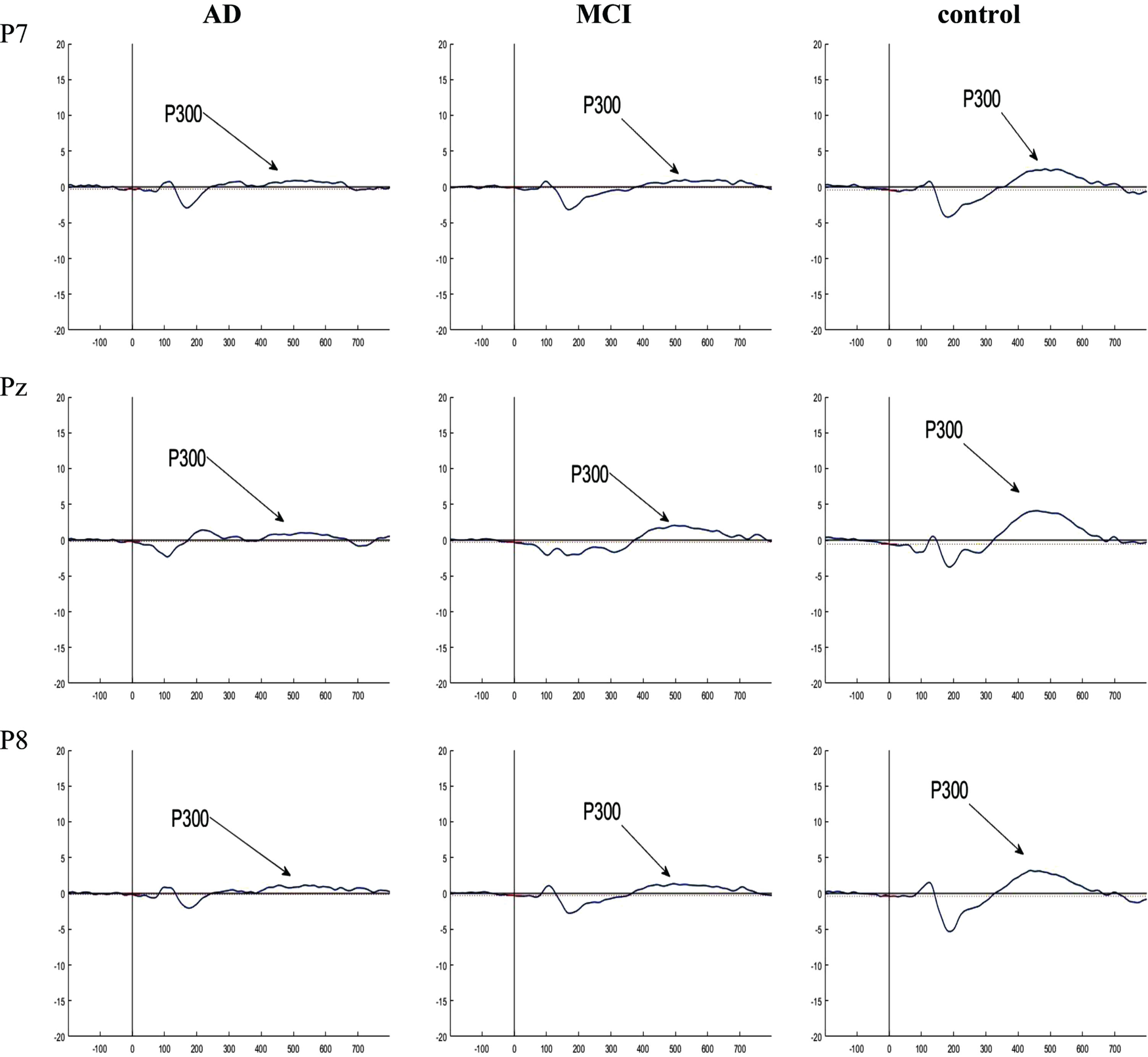 Grand averaged plots of ERPs time-locked to stimulus obtained from 16 AD patients, 16 MCI patients, and 15 controls in P7, Pz, and P8 channels. The P300 components are pointed in figures. In the normal controls, the P300 component showed increased amplitude compared to the AD and MCI groups but no difference in latency.