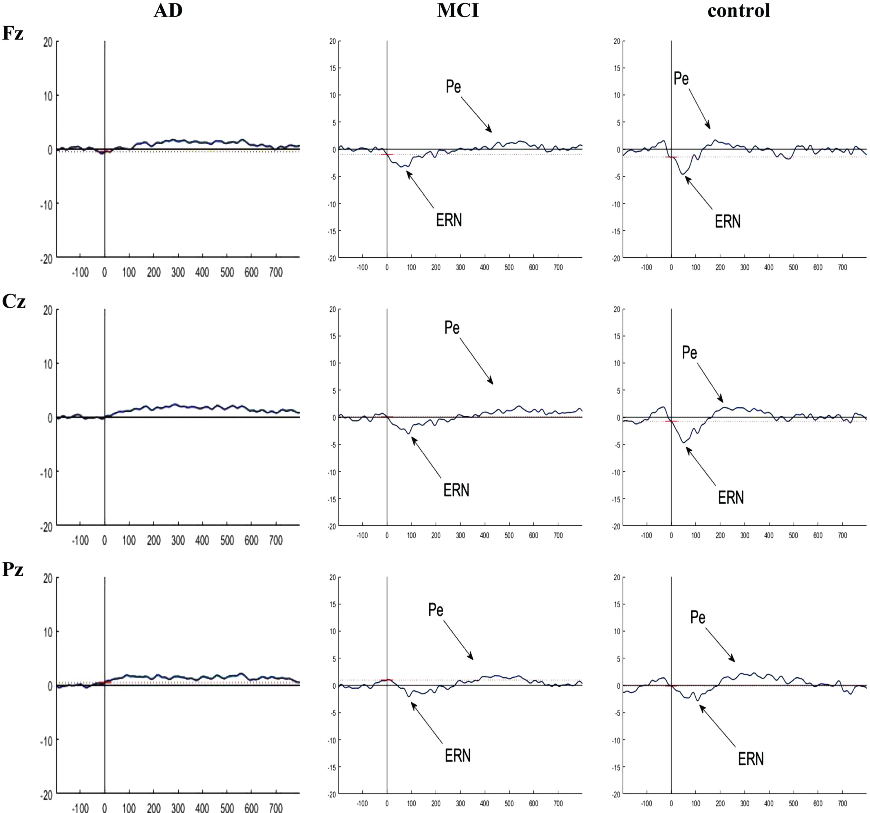 Grand averaged plots of ERPs time-locked to error response obtained from 16 AD patients, 16 MCI patients, and 15 controls in Fz, Cz, and Pz channels. The peaks of ERN and Pe were visible in MCI and control groups but these components did not have obvious peak in AD group. In normal controls, the peak of the ERN showed increased amplitude in Fz and Cz compared to the MCI group, but no difference in latency. There is no difference in the Pe component between the groups.