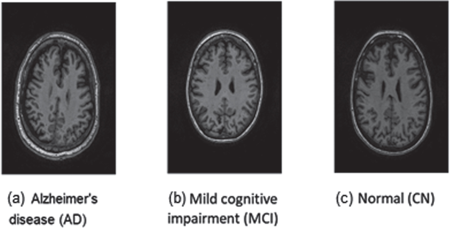 Three different examples of brain images from people with (a) Alzheimer’s disease, (b) mild cognitive impairment, and (c) healthy people.