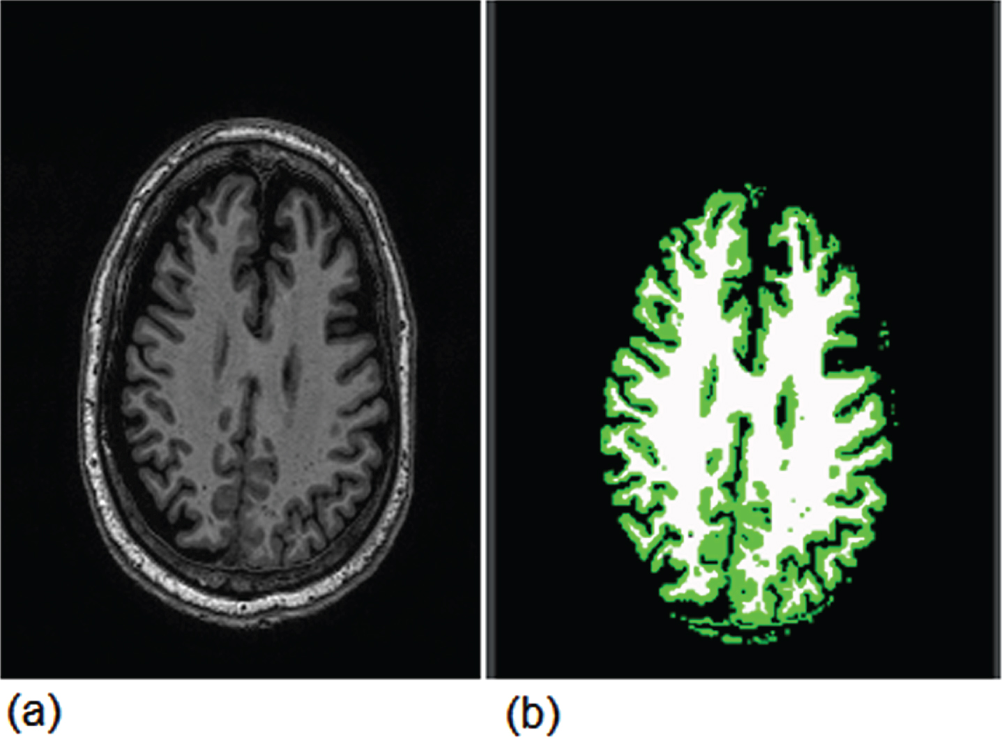 Extraction of gray and white matter areas using image segmentation.
