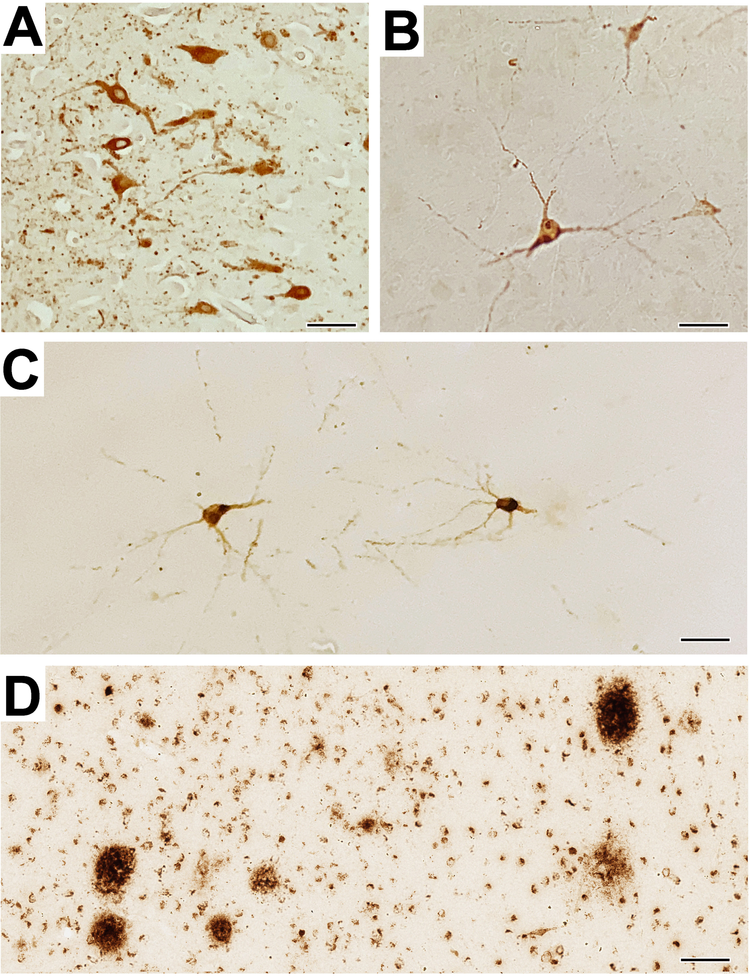 Intraneuronal pTau expression in humans and nonhuman primates. A) Representative immuno-positive pTau staining in the amygdala of a control AD patient, and B) a control very old (29 years) female Japanese macaque. C) Representative pTau neuronal staining in the sole experimental rhesus macaque (a 23-year-old ovariectomized female), showing positive staining of a neuron in a pre-tangle state; none of the other 37 animals showed any positive pTau staining in the amygdala. D) Extensive staining of extracellular Aβ plaques in the amygdala of the same 23-year-old ovariectomized female. In summary, pTau pathology in the rhesus macaques was rare and did not approach the severity of that observed in human AD. Scale bars = 50μm for panels A-C, and 100μm for panel D.