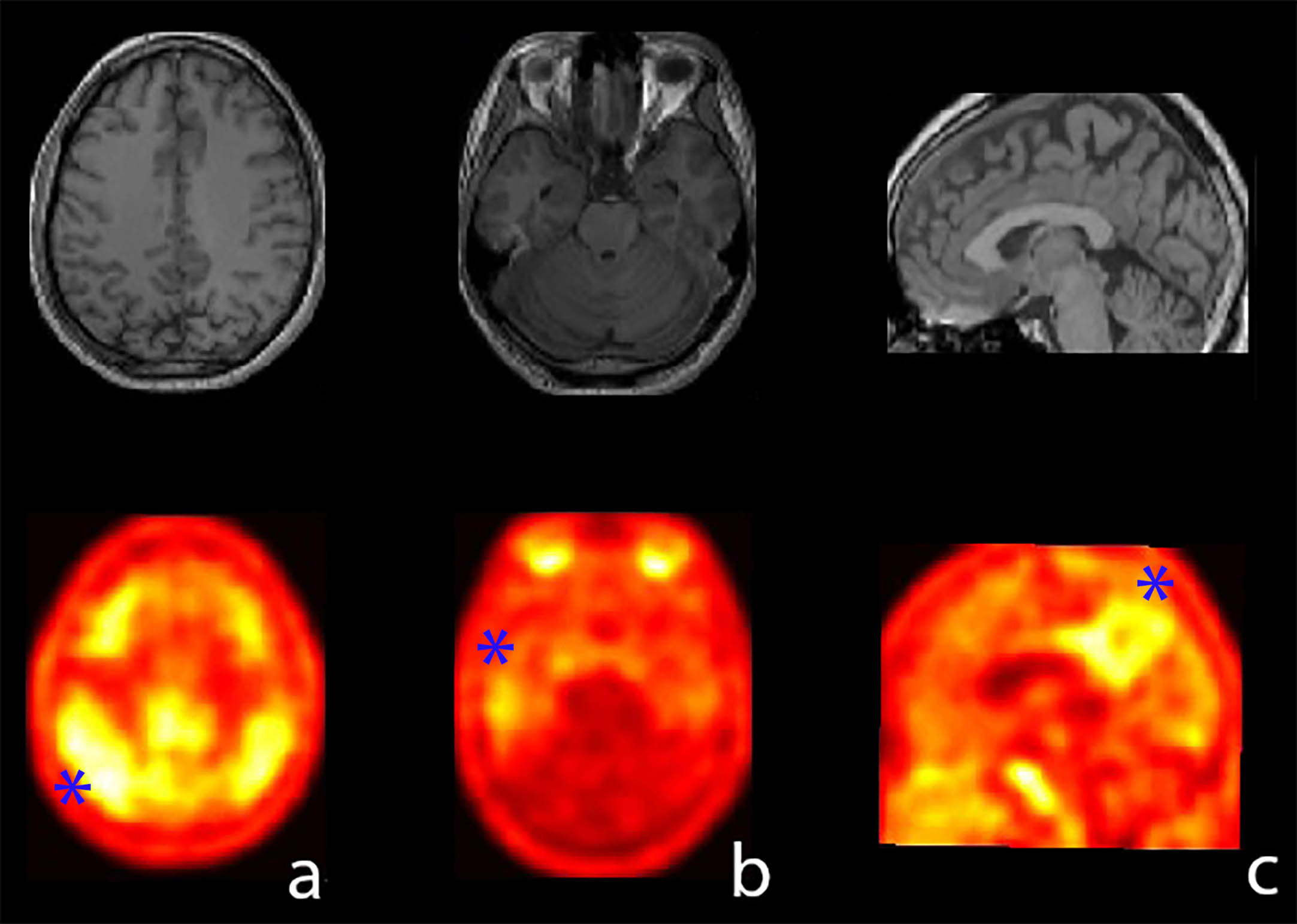 Exemplification case 2. Co-registered PET imaging (bottom) with a template MRI (top) showing a significant increase of tau burden in the parietal (a, blue asterisk) and temporal (b, blue asterisk) cortex presented in axial view. A detail of the parietal cortex showing the right praecuneus burden is provided in (c, blue asterisk).