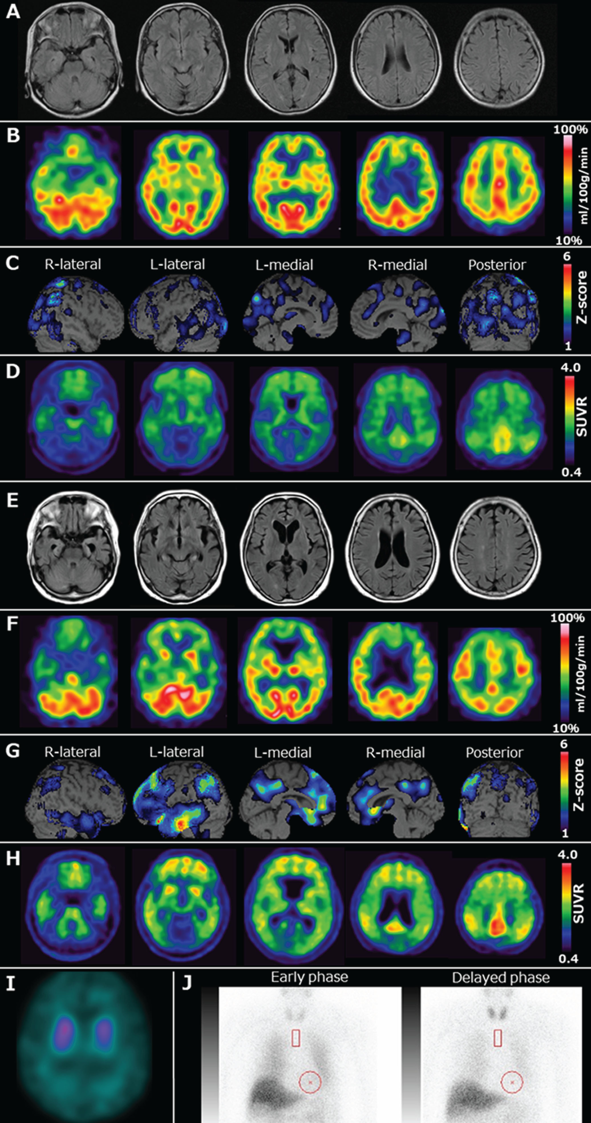 Neuroradiological findings. A) Magnetic resonance fluid-attenuated inversion recovery imaging performed in 2014 showing mild atrophy of the left medial temporal lobes including the hippocampus. B, C) Technetium-99-ethyl cysteinate dimer ([99mTc]ECD) single-photon emission computed tomography (SPECT) and brain perfusion SPECT easy Z-score imaging system (eZIS) analysis (PDRadiopharma Inc., Tokyo, Japan) performed in 2014 showing hypoperfusion in the right parietal lobe, bilateral posterior cingulate gyri, precuneus, and occipital lobes. The color scale for the Z-score is shown in the right part of the figure. Colored areas indicate a Z-score >1. D) Pittsburgh compound-B (PiB) positron emission tomography (PET) standardized uptake value ratio (SUVR) imaging performed in 2014 showing amyloid deposition in the frontal lobes, posterior cingulate gyri, and parietal lobes. The Centiloid scale, calculated using software developed by Matsuda et al. [10], was 45.4. E) Magnetic resonance fluid-attenuated inversion recovery imaging taken in 2023 showing atrophy of the bilateral medial temporal lobes, including the hippocampus, predominantly on the left, and, medial frontal lobes. F, G) [99mTc]ECD SPECT and brain perfusion SPECT eZIS analysis (PDRadiopharma Inc., Tokyo, Japan) performed in 2023 showing hypoperfusion in the left parietal lobe, bilateral posterior cingulate gyri, precuneus, left frontal lobes, and left medial and lateral temporal lobes. The color scale for the Z-score is shown in the right part of the figure. Colored areas indicate a Z-score >1. H) PiB-PET SUVR image taken in 2023 showing more amyloid deposition in the frontal lobes, posterior cingulate gyri, and parietal lobes, compared to that in 2014. The Centiloid scale was 98.1. I) 123I-N-omega-fluoropropyl-2-beta-carbomethoxy-3-beta-(4-iodophenyl) nortropane SPECT revealing a marked reduction in dopamine transporter (DAT) availability in the bilateral whole striatum based on a visual assessment. The quantitative analysis also indicated DAT reduction. The average specific binding ratio (SBR) for the whole striatum, calculated using the DaTView software (AZE Corp., Tokyo, Japan), was 2.50 (right striatal SBR = 2.86, left striatal SBR = 2.14). J) 123I-metaiodobenzylguanidine myocardial scintigraphy showing a decrease in the heart-to-mediastinum ratio in both the early and delayed phase and an increased washout ratio (early phase: 1.63 = delayed phase = 1.22; washout rate = 41.4%).