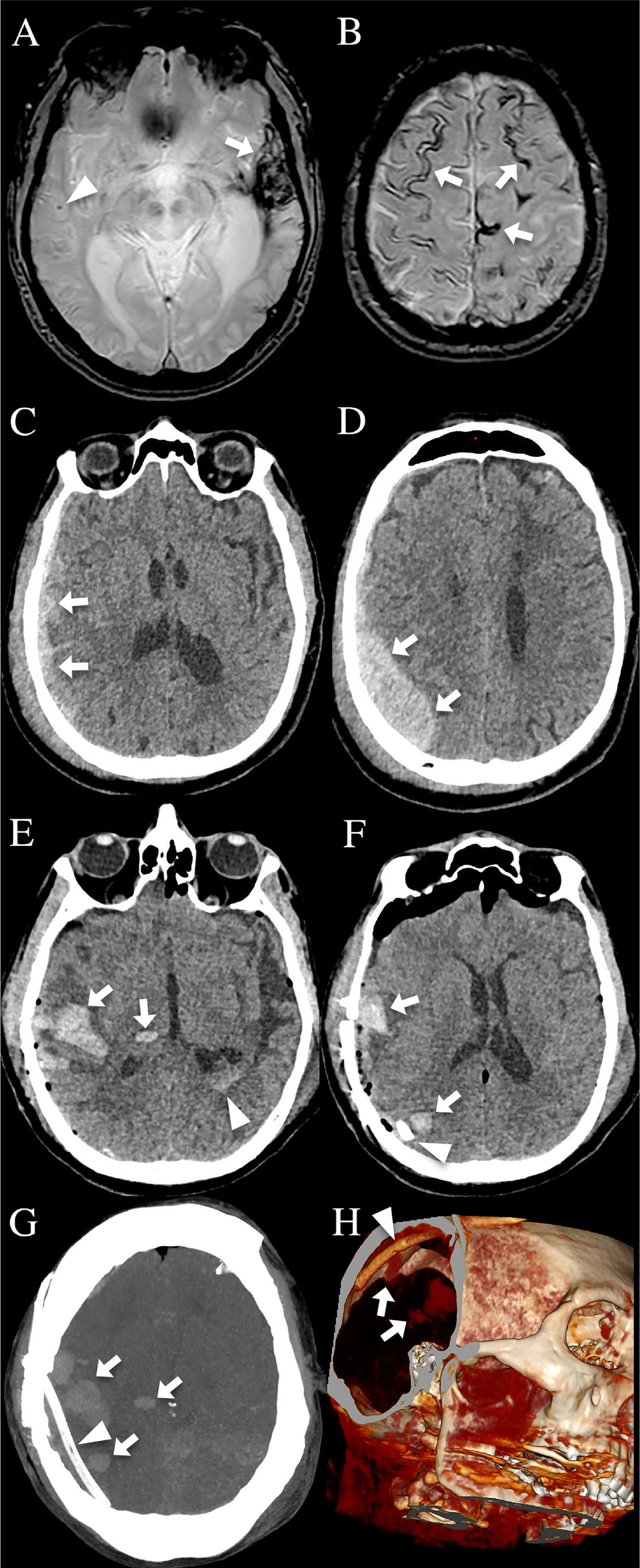 CAA patient 1 showing chronic ICH (A, arrow), cerebral microbleed (A, arrowhead), and cortical superficial siderosis (B, arrows) on MRI performed six months before head trauma. After major blunt head trauma, sub- (C) and extradural (D) hemorrhage can be observed on CT. After hemorrhage evacuation, a subdural drain (F, G, and H, arrowhead) was inserted complicated by multiple lobar and deep ICH intracerebral (E-H, arrows) in brain regions earlier compressed by the initial extra/subdural hemorrhage and in front of the subdural drain (E and F are standard CT images, G 2D and H 3D multiplanar reconstruction CT images) together with intraventricular hemorrhage (E, arrowhead) on postoperative CT.