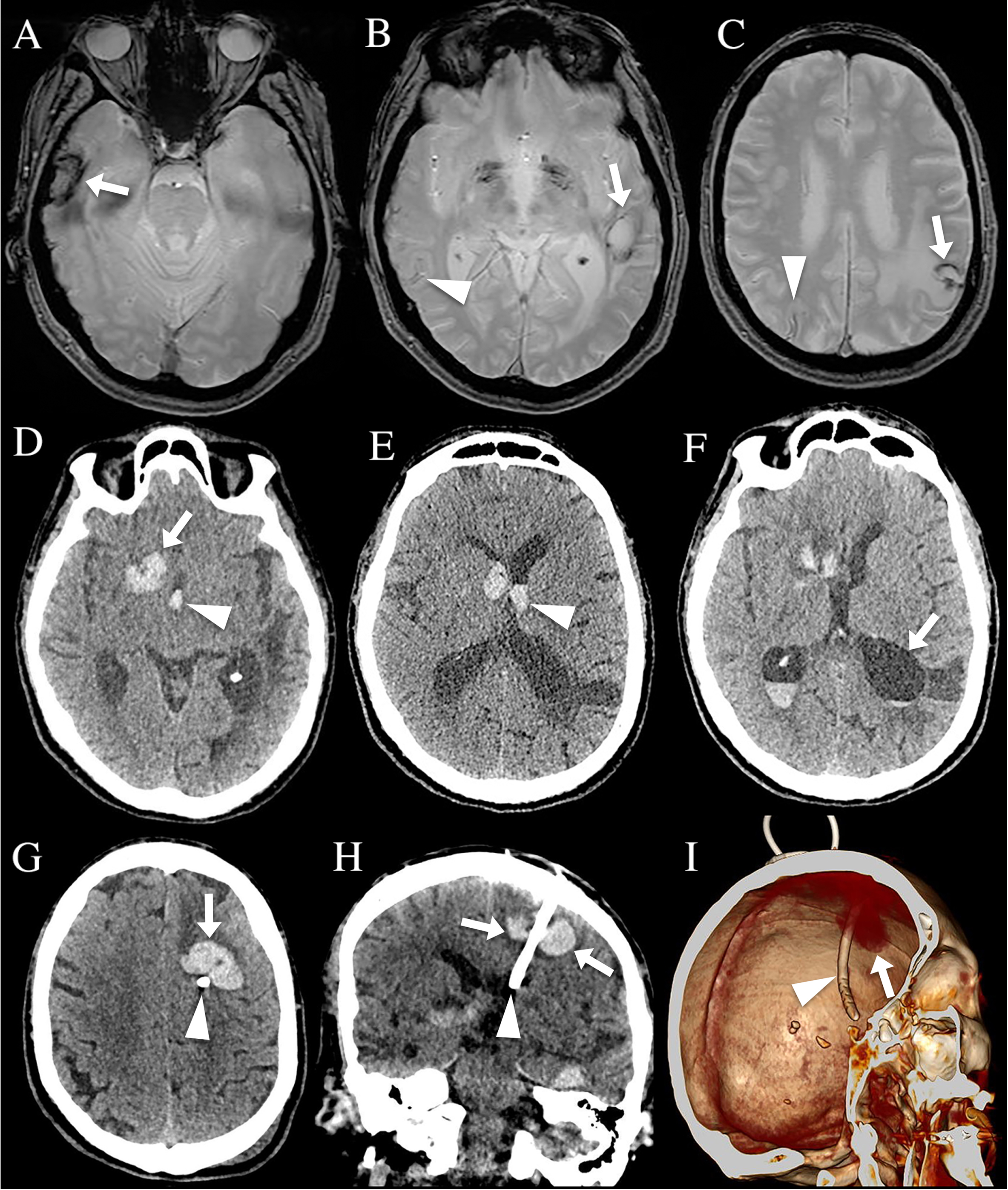 CAA patient 2 showing multiple chronic ICH (A-C, arrows) and cortical superficial siderosis (B and C, arrowheads) on MRI, four months before recurrence of acute ICH. Acute right frontal lobar subcortical ICH (D, arrow) associated with intraventricular hemorrhage extension (D and E, arrowheads) can be observed on CT. After three days, the patient’s state worsened and CT showed occurrence of hydrocephalus (F). A left frontal intraventricular drain was inserted. Postoperative CT showed ICH (arrows) surrounding the intraventricular drain (arrowhead) an axial (G) and coronal (H) CT images and on 3D multiplanar reconstruction images (I).