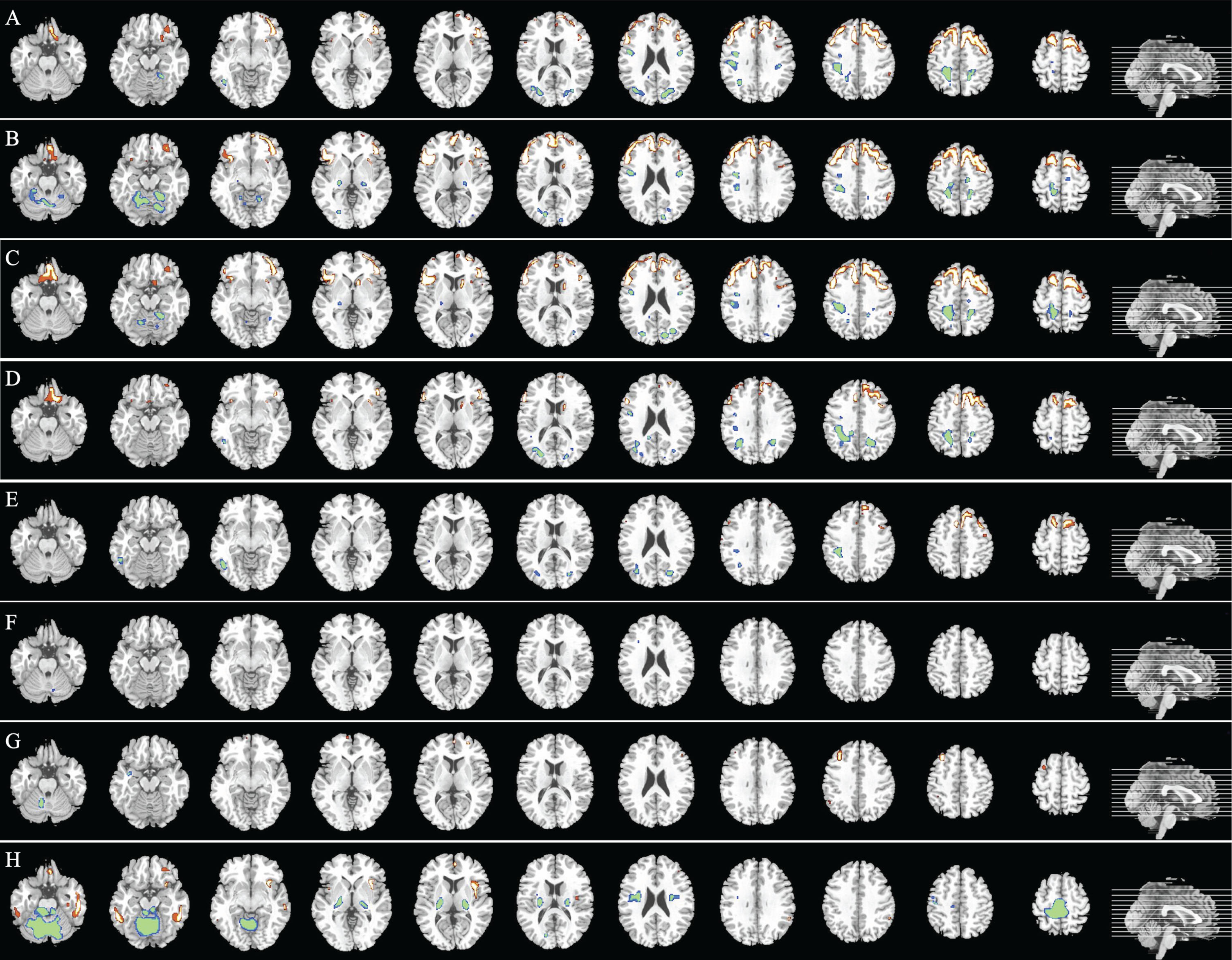 Differential distribution of glucose metabolism between FTD and AD dementia (MCI and three AD subtypes), as well as between MCI and three AD subtypes groups. A) MCI and AD versus FTD: Regions highlighted in red (former) indicate areas of higher metabolism in MCI and AD than in FTD, while green (later) indicates the reverse. This color scheme applies to all subsequent comparisons. B) MCI versus FTD. C) mild AD versus FTD. D) moderate AD versus FTD. E) moderate-severe AD versus FTD. F) MCI versus mild AD. G) MCI versus moderate AD. H) MCI versus moderate-severe AD. FTD, frontotemporal dementia; AD, Alzheimer’s disease; MCI, mild cognitive impairment.