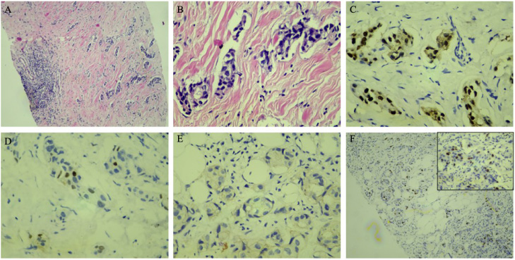 Case #15: H&E sections (A, ×40; B, ×100 magnification) demonstrate invasive ductal carcinoma of the breast which is diffusely positive for ER (C) and shows sparse PR-positivity (D) while negative for HER2 (0 intensity) (E) and KI67-low (F).