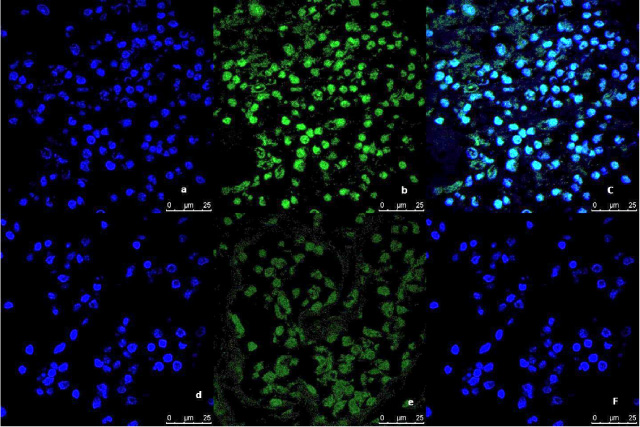 Representative image of the immunofluorescence analysis of LC3B expression in breast tumor tissue culture system examined and imaged by Leica Confocal microscope (Confocal microscopy 200×). a,b,c immunofluorescence staining in Tumor tissues cultured without anti-IL8 mab. a: DAPI nuclear staining (blue). b: LC3B staining showing fluorescence intensity  >10 pixel/μm2 for Alexafluor 488 staining (Green) indicating high LC3B expression. c: Merged image. d,e,f: immunofluorescence staining in tumor tissues cultured with anti-IL8 mab. d: DAPI nuclear staining (blue). e: LC3B staining showing fluorescence intensity  <2 pixel/μm2 for Alexafluor 488 staining (Green) indicating low LC3B expression. c: Merged image.