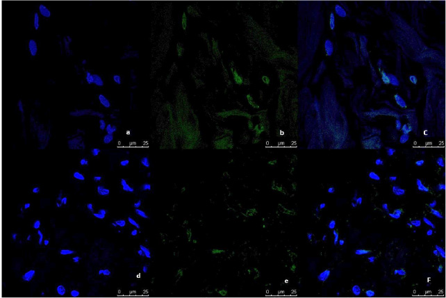 Representative image of the immunofluorescence analysis of LC3B expression in breast normal tissue culture system, examined and imaged by Leica Confocal microscope (Confocal microscopy 200×). a,b,c: immunofluorescence staining in normal tissues cultured without anti-IL8 mab. a: DAPI nuclear staining (blue). b: LC3B staining showing fluorescence intensity  <2 pixel/μm2 for Alexafluor 488 staining (Green) indicating low LC3B expression. c: Merged image. d,e,f: immunofluorescence staining in normal tissues cultured with anti-IL8 mab. d: DAPI nuclear staining (blue). e: LC3B staining showing fluorescence intensity  <2 pixel/μm2 for Alexafluor 488 staining (Green) indicating low LC3B expression. c: Merged image.