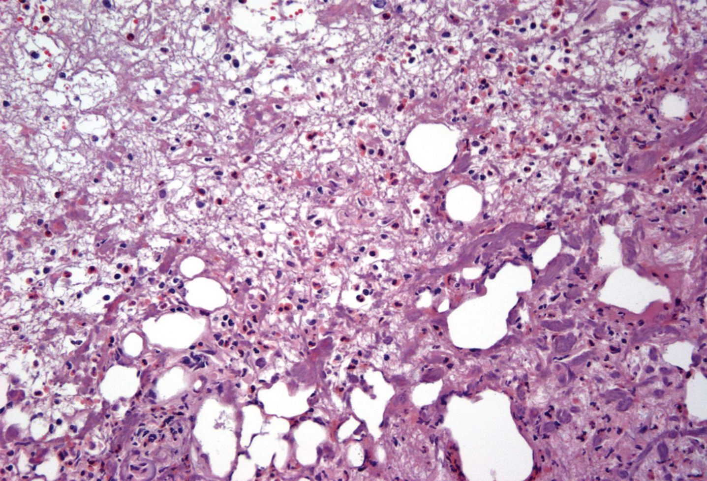 Bladder biopsy of Mitomycin-C cystitis. Biopsy demonstrates numerous eosinophils consistent with MMC induced cystitis.
