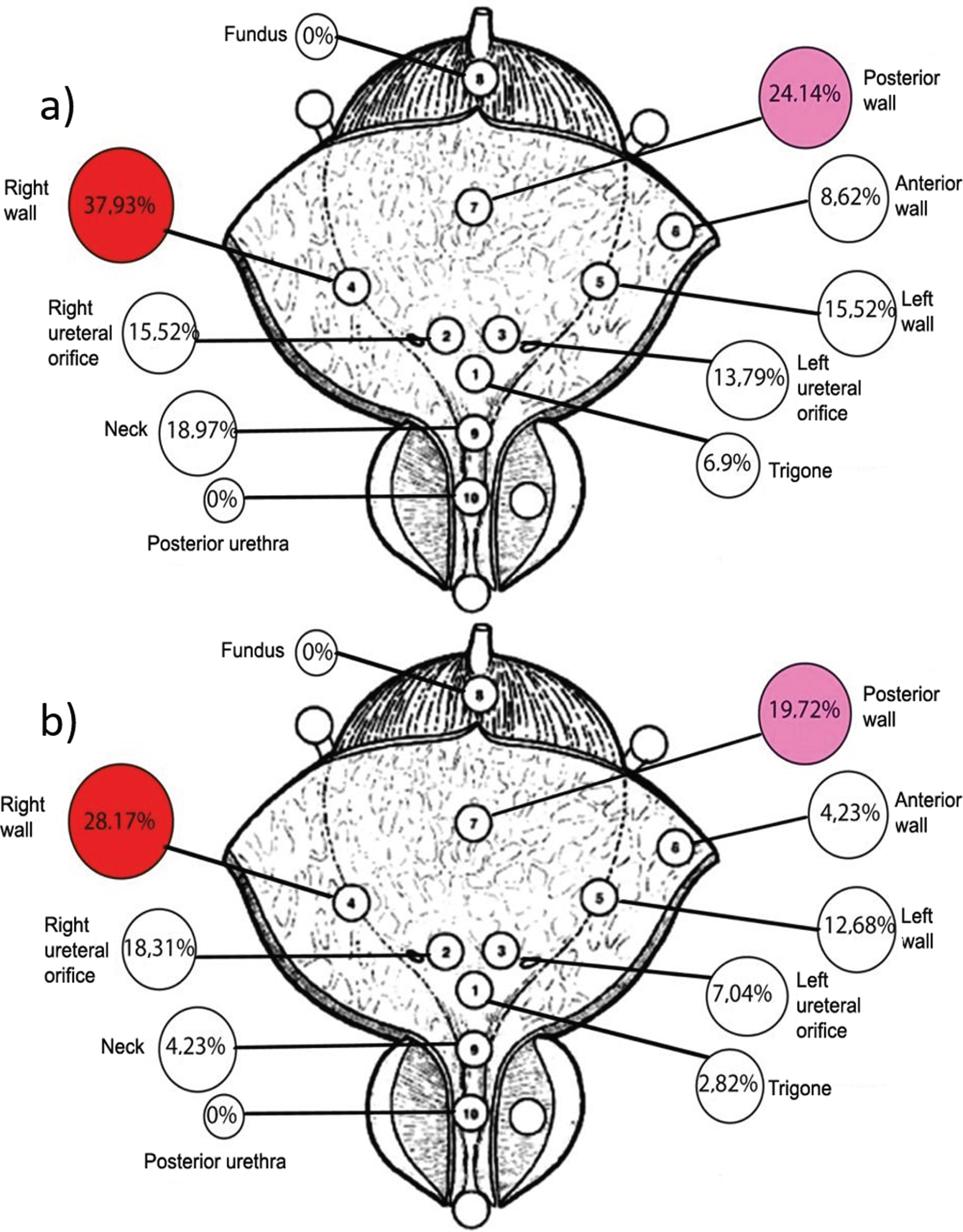 Tumor location in the a) TURBT group; b) Tm-fiber ERBT group.