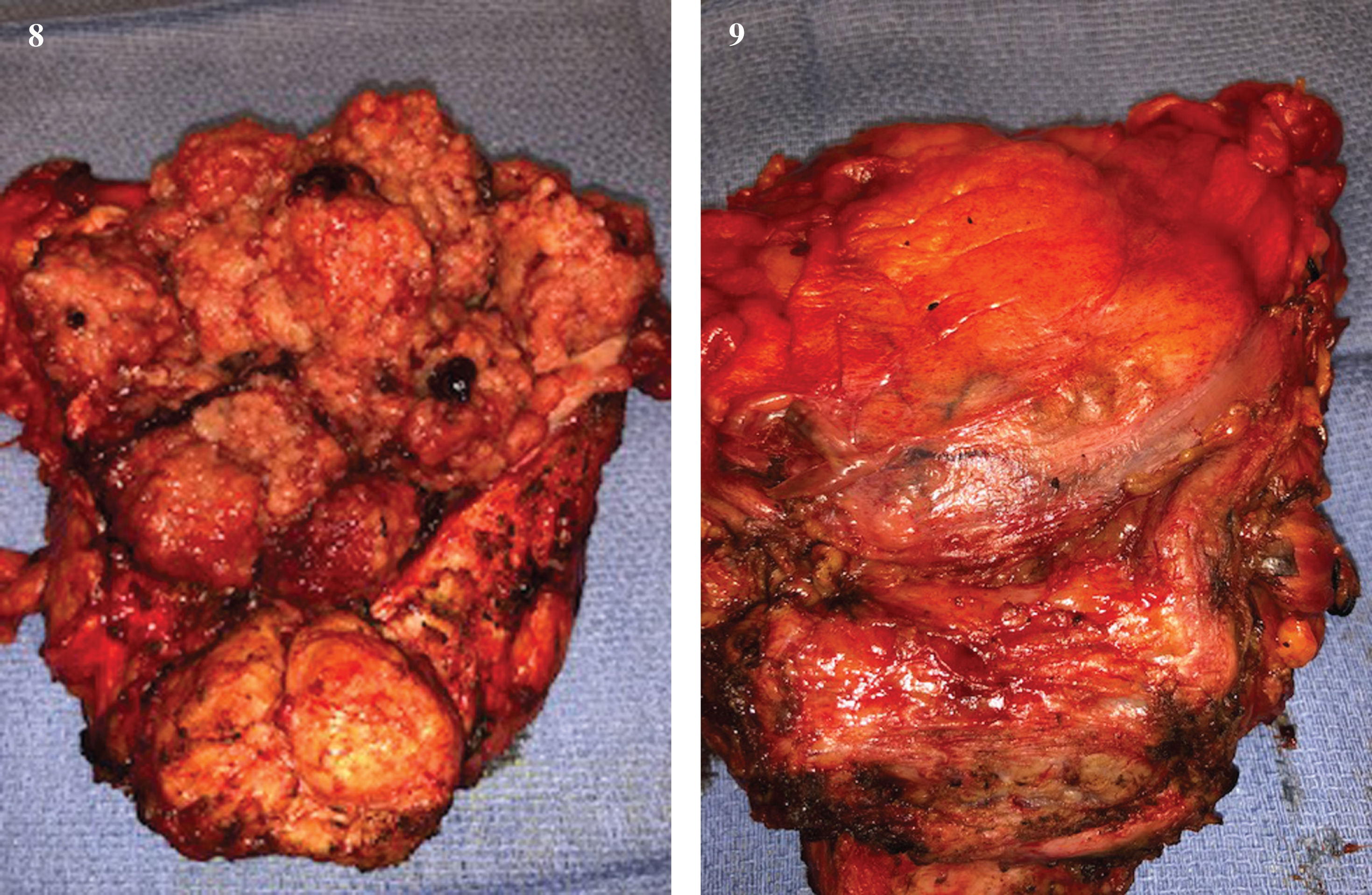 Open bladder/prostate, anterior and posterior.