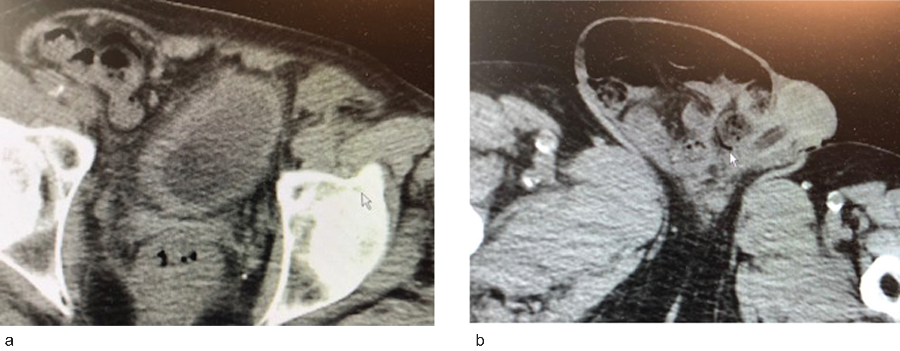 a. CT scan indicated two small kidneys, no hydronephrosis and a small bladder with a urethral catheter. b. A large right inguinal scrotal hernia.