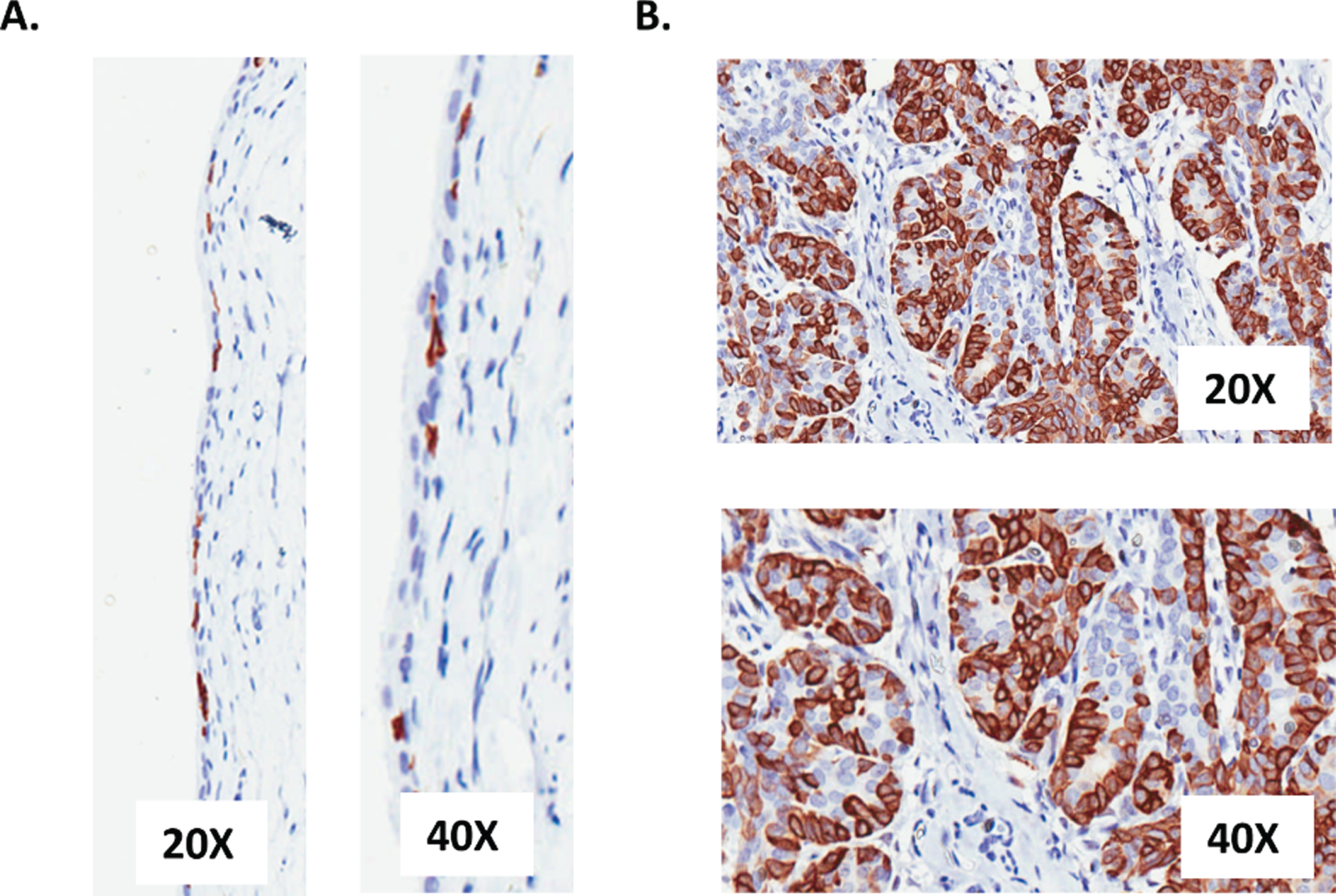 Representative images of keratin 5 expression in (A) normal bladder tissue obtained from 12-week old, untreated rats and (B) transitional cell cancers from a female F344 rat that had been treated with OH-BBN. The OH-BBN-treated rat in (B) was palpated twice per week starting 4 months after the final dose of OH-BBN and the animal was euthanized 5 days after the detection of a palpable tumor. The images were taken at 20X and 40X magnification.