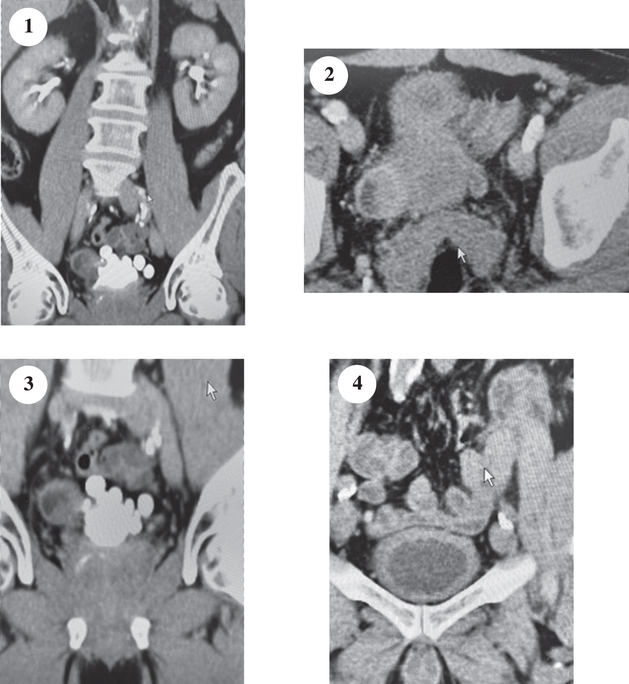 The CT scan of the abdomen and pelvis indicate a normal upper urinary tract. There is a mass associated with a bladder diverticulum arising from the right side of the bladder. There are multiple bladder diverticuli as seen in the image post contrast. The bladder is moderately thick.