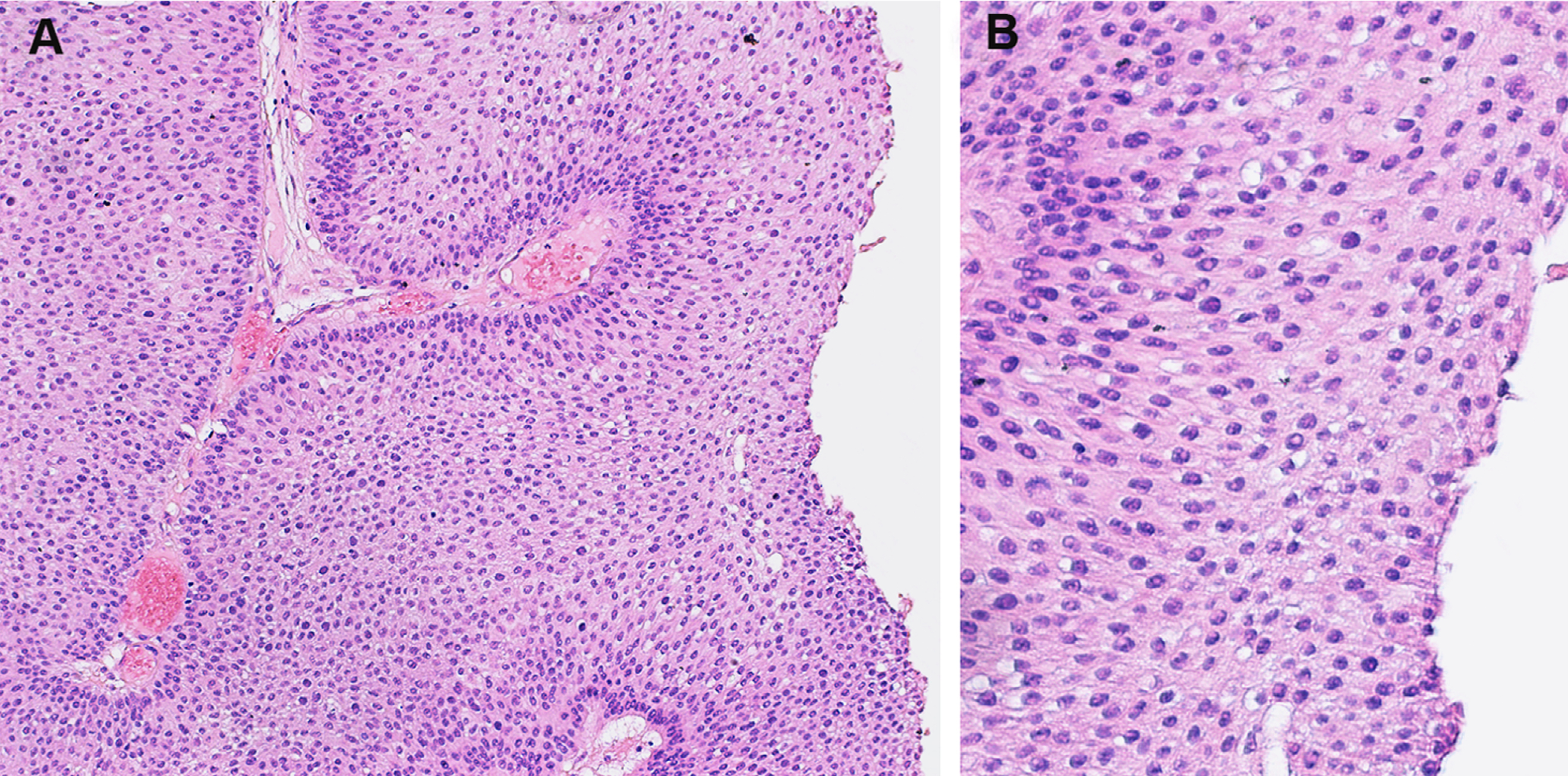 Papillary urothelial neoplasm of low malignant potential. A. The overlying urothelium is thickened (×100). B. The urothelium shows minimal cytologic atypia (×200).