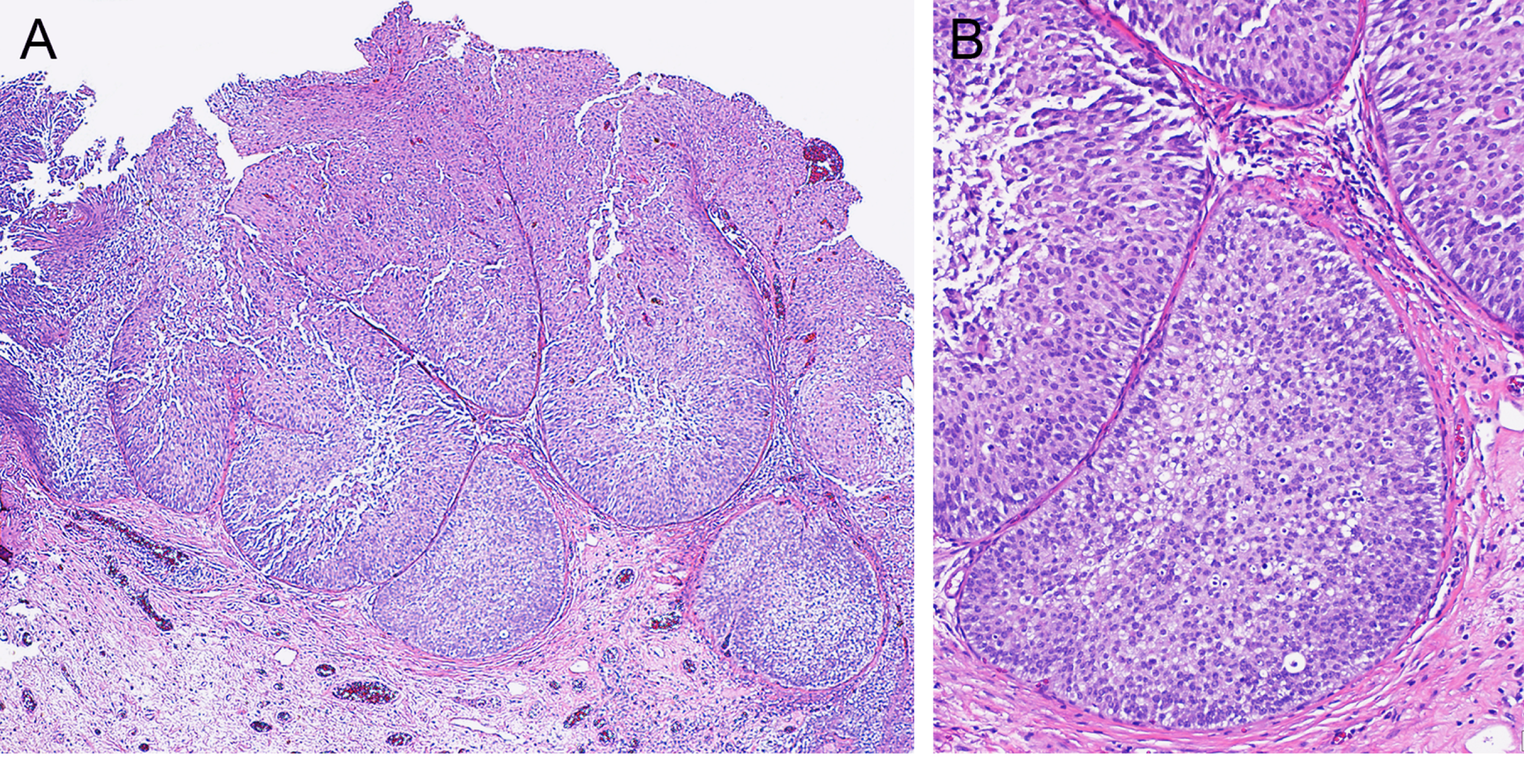 Papillary urothelial carcinoma shows an inverted growth pattern. A. The tumor shows large nests with broad pushing borders in the lamina propria (×40). B. The tumor shows low-grade features (×100).