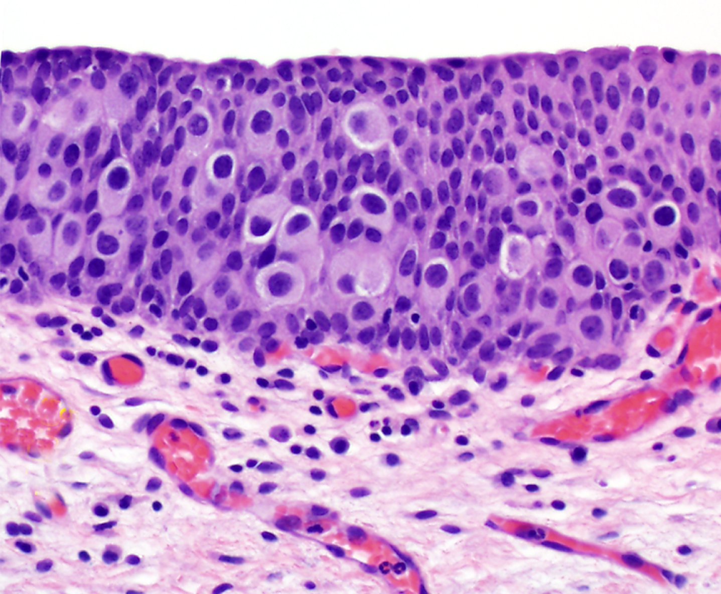 Urothelial carcinoma in situ shows a pagetoid growth pattern (×200).
