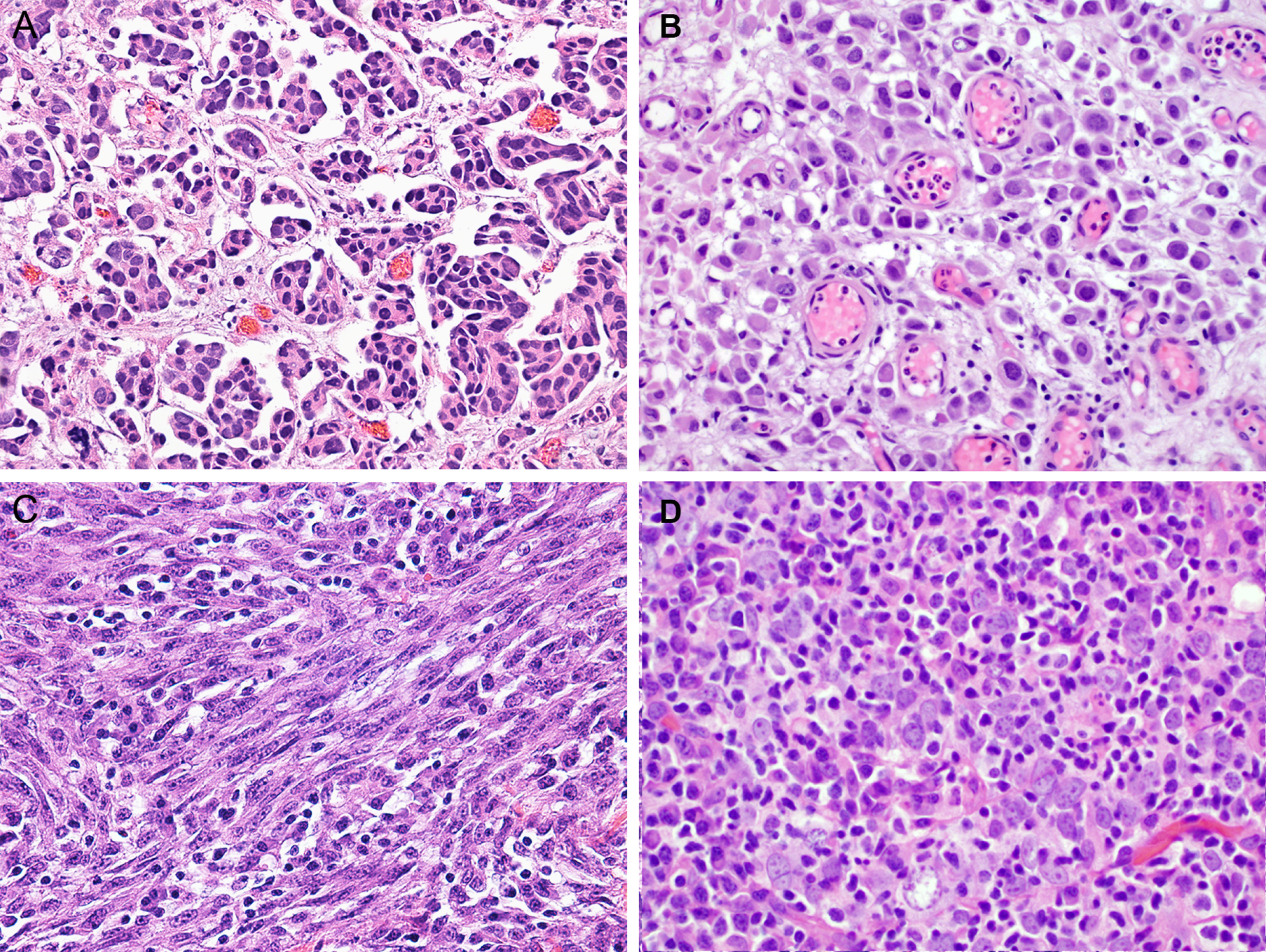 Different urothelial carcinoma subtypes. A. Micropapillary (×200). B. Plasmacytoid (×200). C. Sarcomatoid (×200). D. Lymphoepithelioma-like subtype (×200).