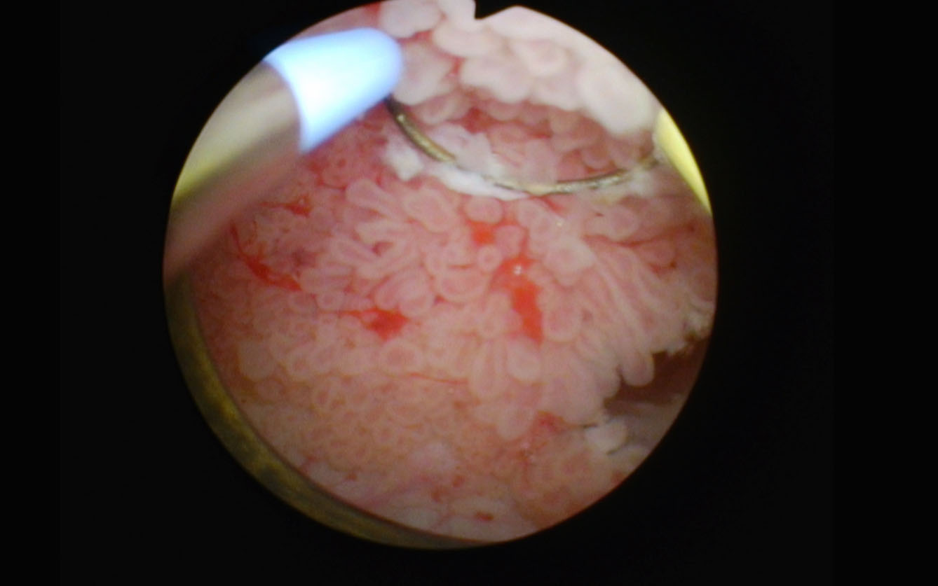 4 cm anterior papillary low grade appearing tumor.