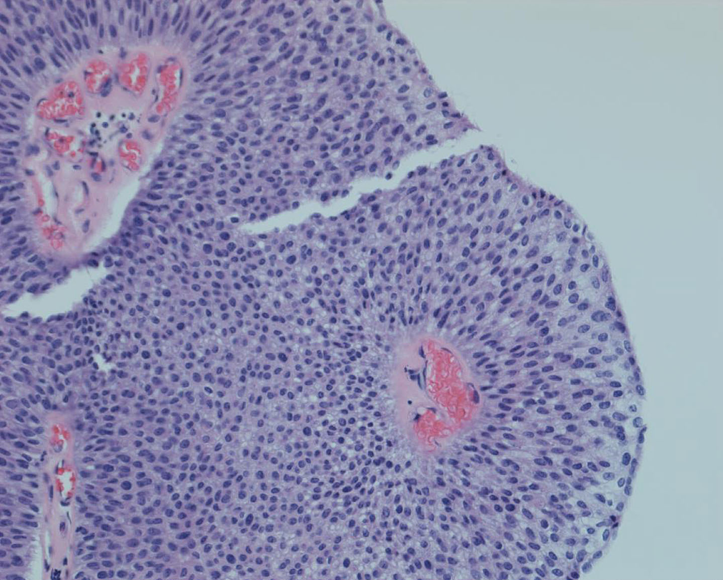 Low grade non invasive papillary urothelial tumor.