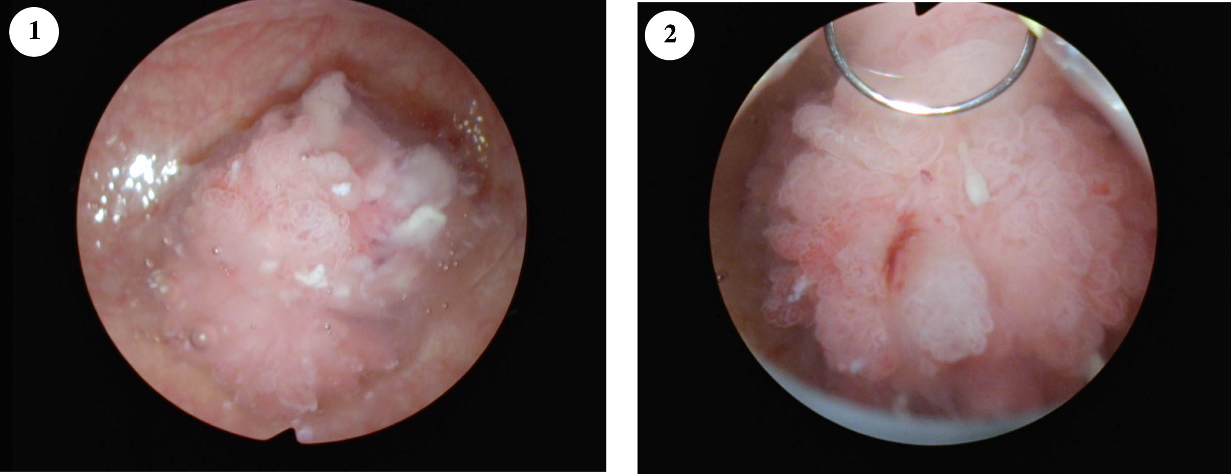 Papillary solitary 3–4 cm tumor posterior wall.