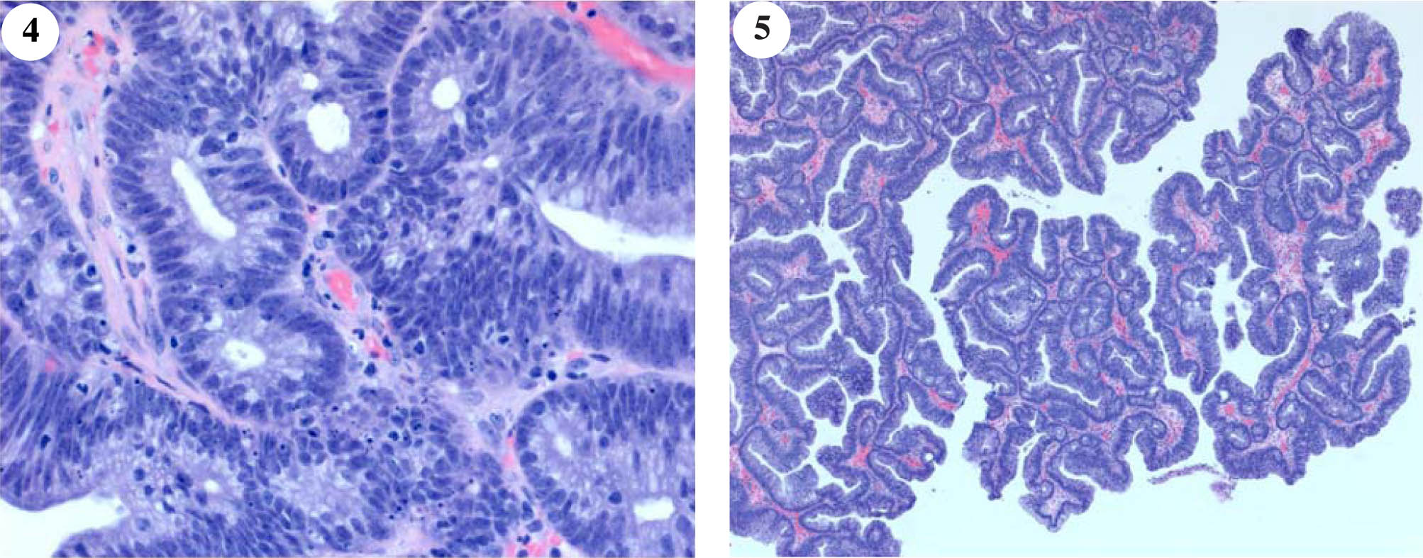 Histology of the tubulovillous adenoma of the bladder. Description in the text.