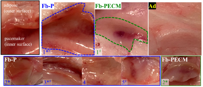 Images of Fb-P (fibrous tissue from pacemaker only, n = 5), Fb-PECM (fibrous tissue from pacemaker in ECM envelope, n = 2), and Ad (adipose control) surrounding tissues. Fibrous tissues are located inside the dashed outlines for both samples labeled “1”. *Fb-P samples: 1–3 and Fb-PECM: 2 had pronounced fibrous connective tissue appearance. #Fb-P: 1, 3, and 5, and Fb-PECM: 1 had some regions of hematoma.