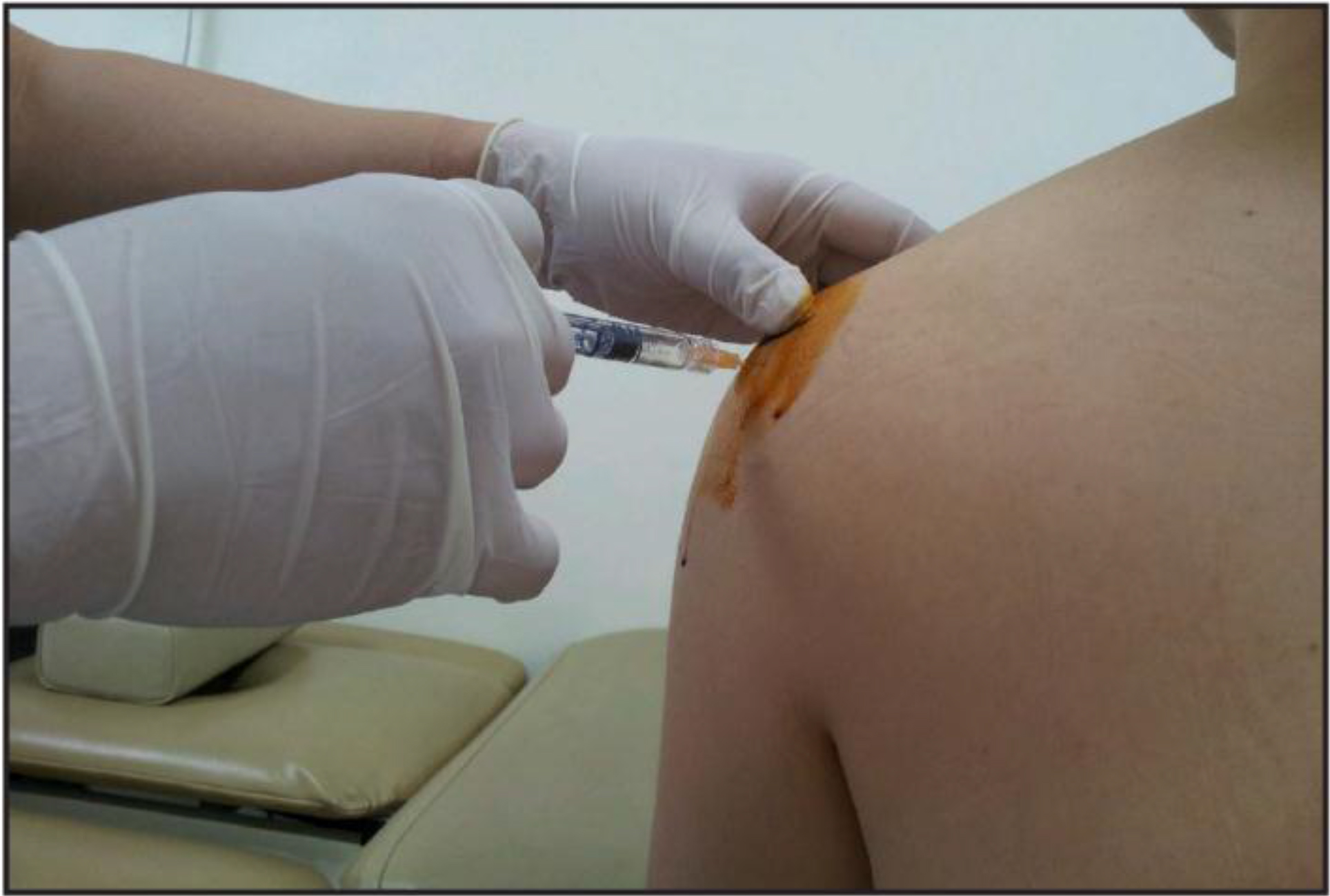 Posterior technique for shoulder intra-articular injection.