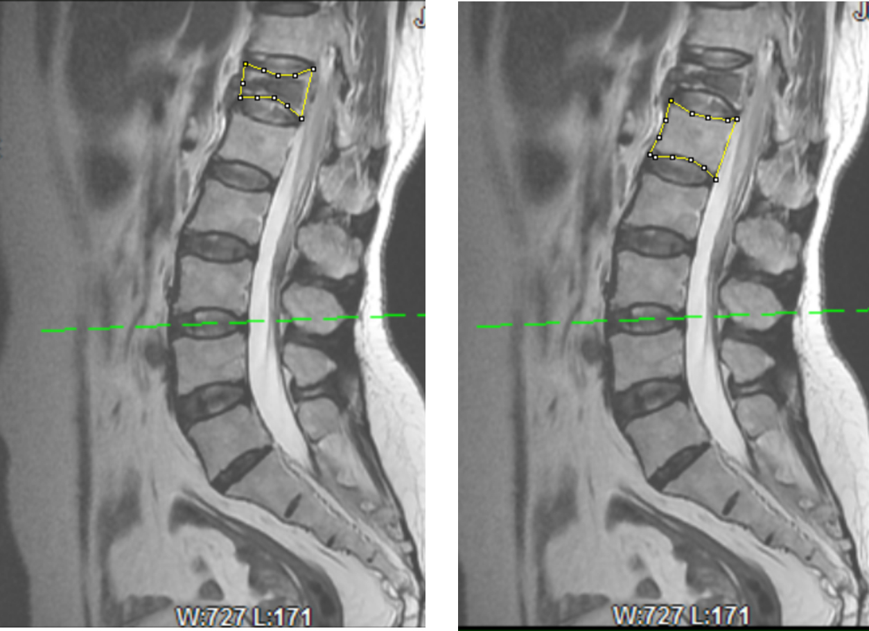 Segmentations of Vertebral body boundary. The median sagittal T2-weighted MRI was selected, and the vertebral body boundary was selected by Image J software, then the fractured vertebra sagittal cross-sectional area (FSCSA) and the adjacent normal vertebral body sagittal cross-sectional area (NSCSA) were measured.