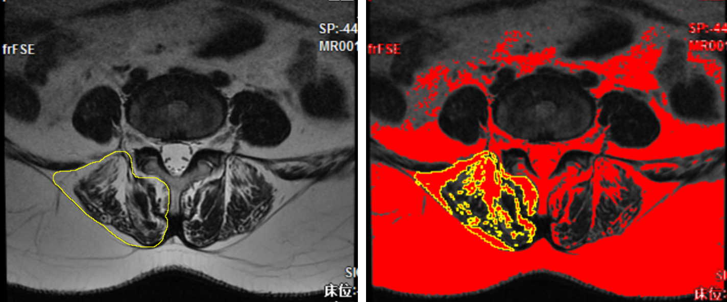 Measurement of paraspinal muscle and fat cross-sectional area. Intervertebral disc level on axial T2-weighted MRI were selected, and the boundary of paraspinal muscles (including erector spinae and multifidus) was depicted by Image J software and paraspinal muscles cross-sectional area (CSA) was measured. Threshold method was used to select intra-spinal adipose tissue and fat cross-sectional area (FCSA) was measured.