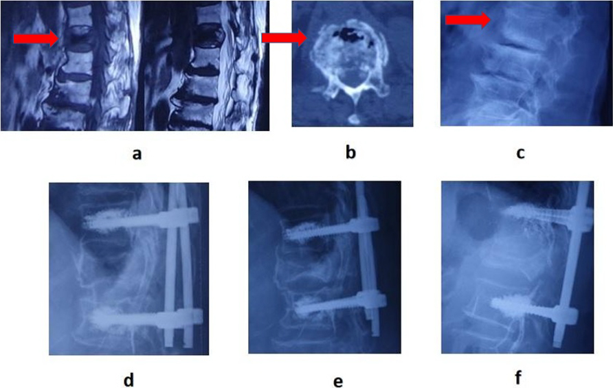A 68-year-old man was admitted to hospital for back pain. MRI showed low signal in both T1 and T2 images. b, CT showed IVC sign; c, X-ray showed vertebral compression; d, one week after operation; e, three months after operation; f, two years after operation.