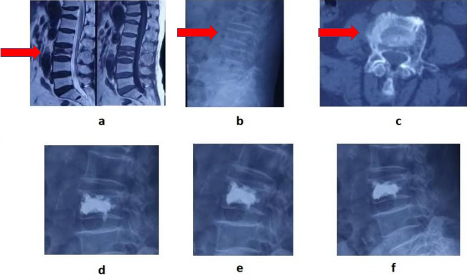 A 83-year-old female patient with back pain was hospitalized, L3 vertebral body was compressed, and there was no lower limb nerve dysfunction. a, MRI showed low signals, in both T1 and T2 of the injured vertebrae with “IVC sign” of the vertebrae. X-ray and CT showed vertebral compression fractures b and c. Percutaneous vertebroplasty was performed one week after operation, three months after operation, and two years after operation d, e, f.