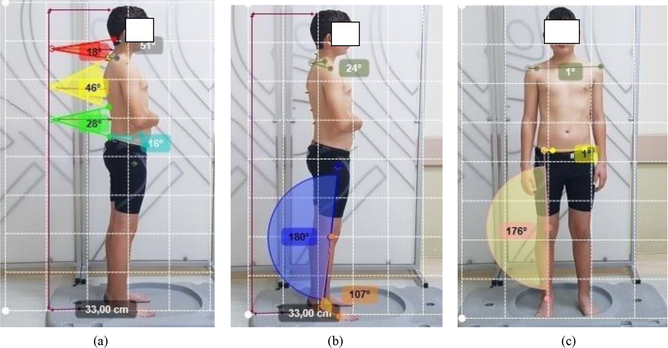 Images taken with admission for analysis of posture parameters with Kinovea®; a) Spinopelvic posture angles in sagittal plane; grey angle for craniovertebral, red angle for cervical lordosis, yellow angle for thoracic kyphosis, green angle for lumbal lordosis, and blue angle for sagittal pelvic tilt; b) Extremity posture angles in sagittal plane; khaki angle for shoulder protraction, dark blue angle for knee flexion, and dark orange angle for ankle plantar flexion [calculated by the formula (angle obtained with Kinovea®)–90]; c) Posture angles in frontal plane; dark green angle for shoulder asymmetry, yellow angle for pelvis asymmetry, and pink angle for knee valgus.